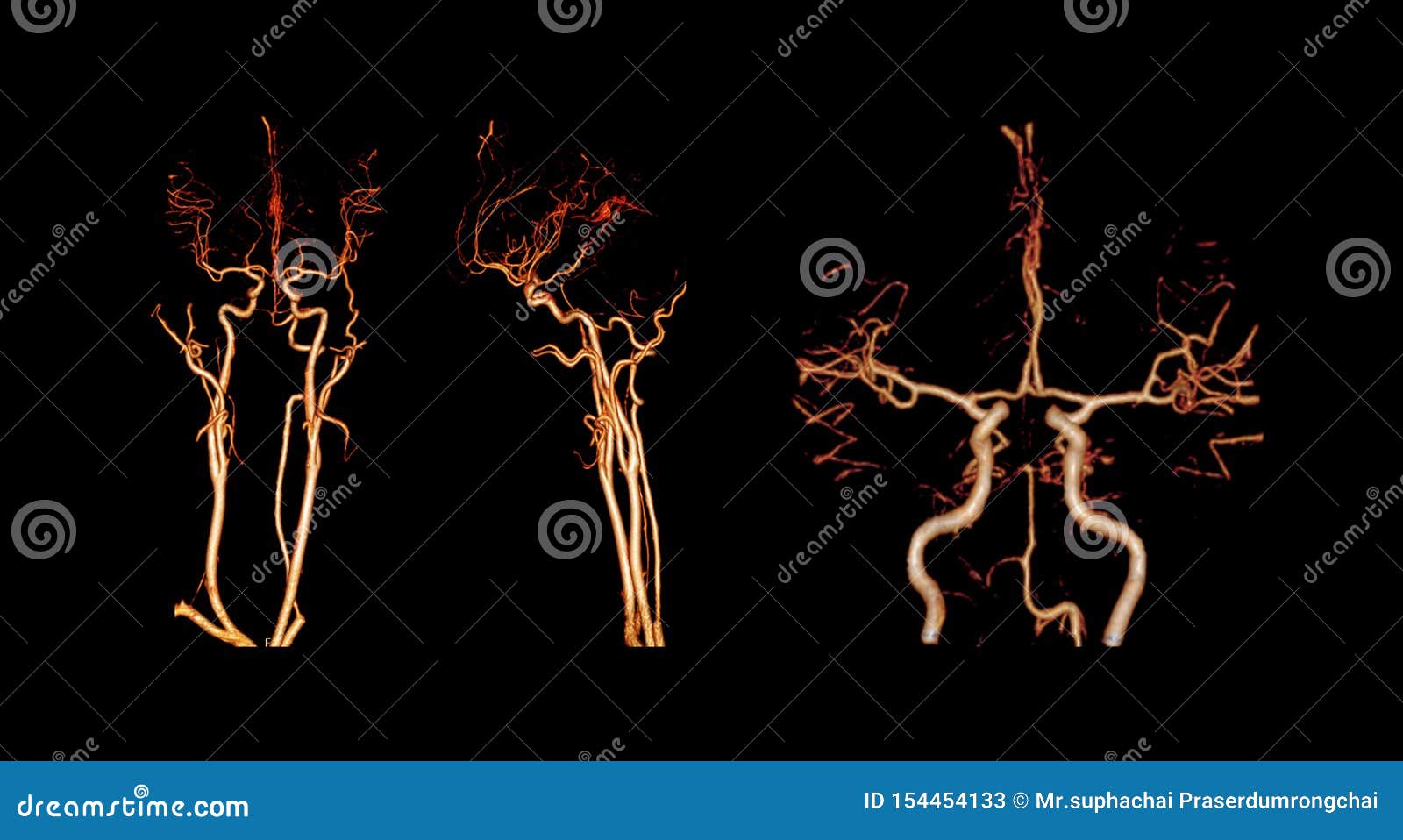 cta brain os ct angiography of the brain  3d rendering image.