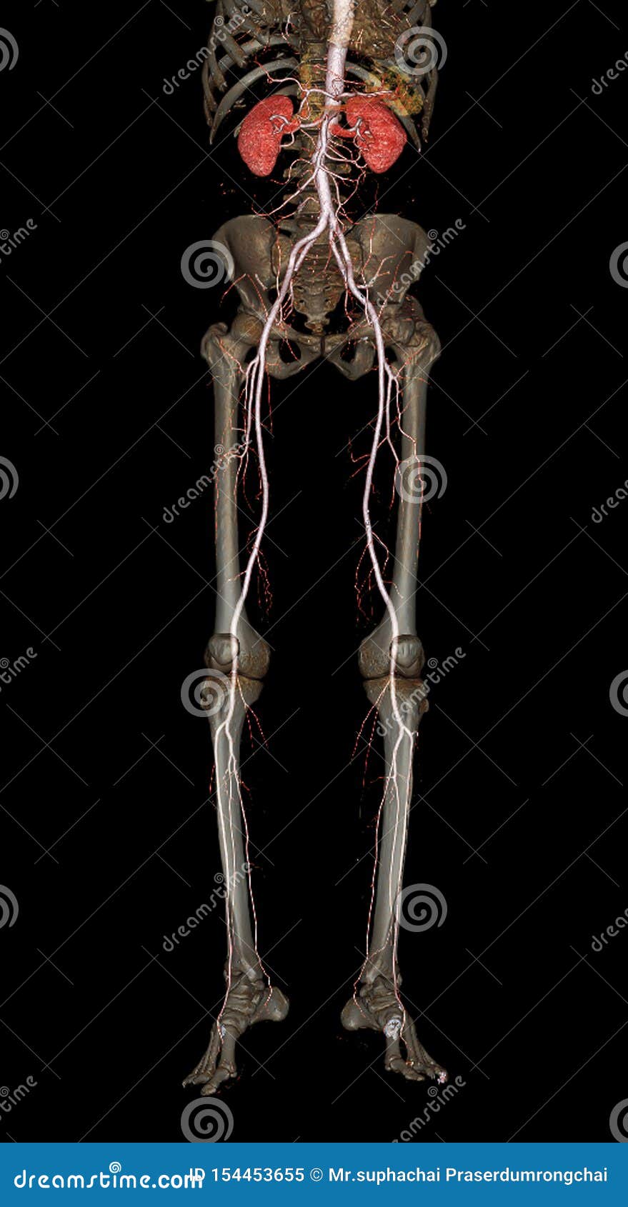 cta femoral artery run off  3d rendering image