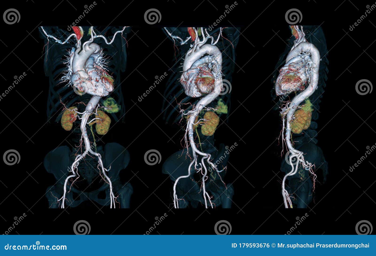 cta whole aorta 3d rendering image.