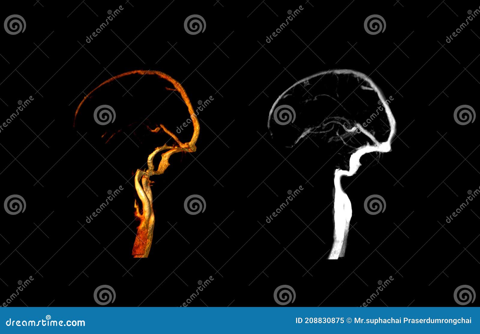 ctv brain lateral view compare 3d and mip image