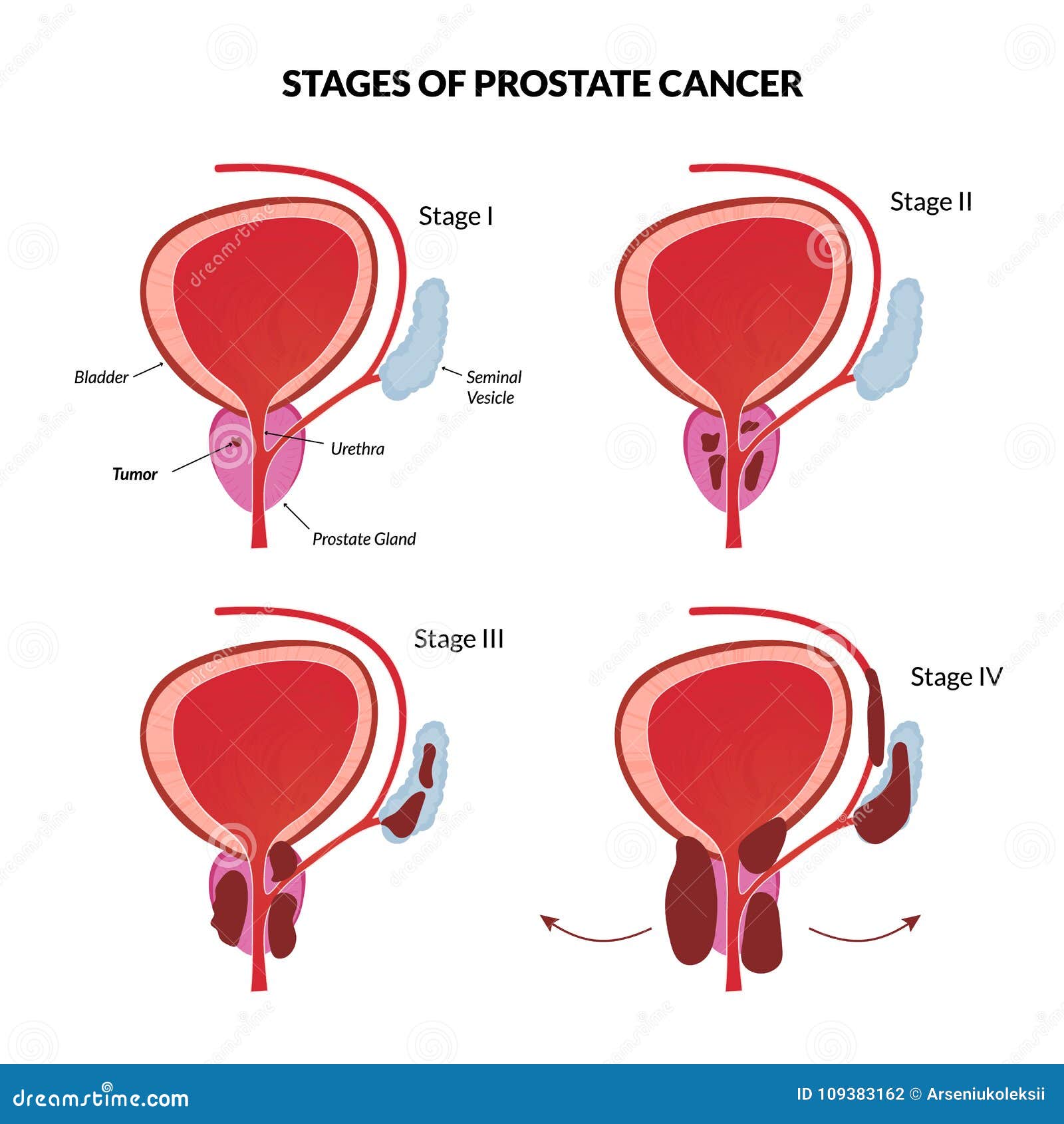 Cancer de prostata estadios