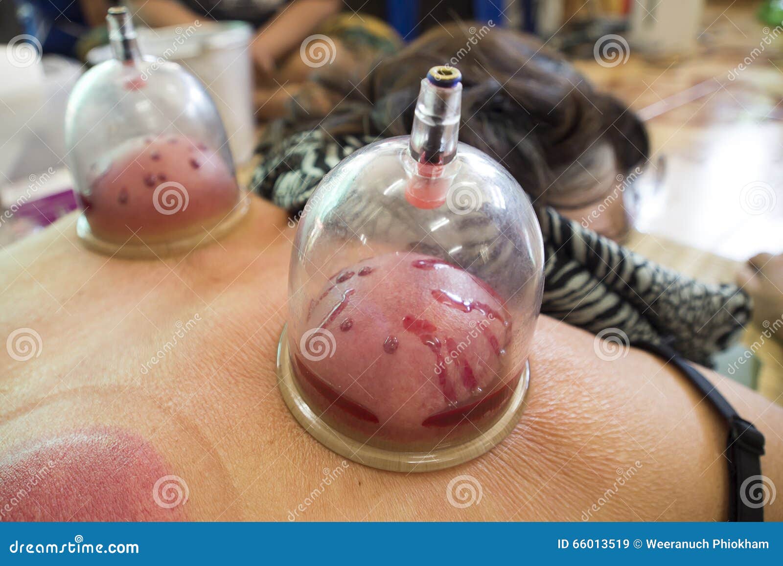 Cupping,traditional Chinese Medicine Stock Image - Image ...