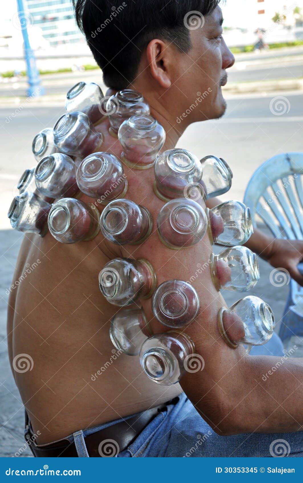 Cupping Treatment Therapy Saigon Vietnam Editorial Image Image Of cupping-treatment-therapy-saigon-vietnam-editorial-image-image-of