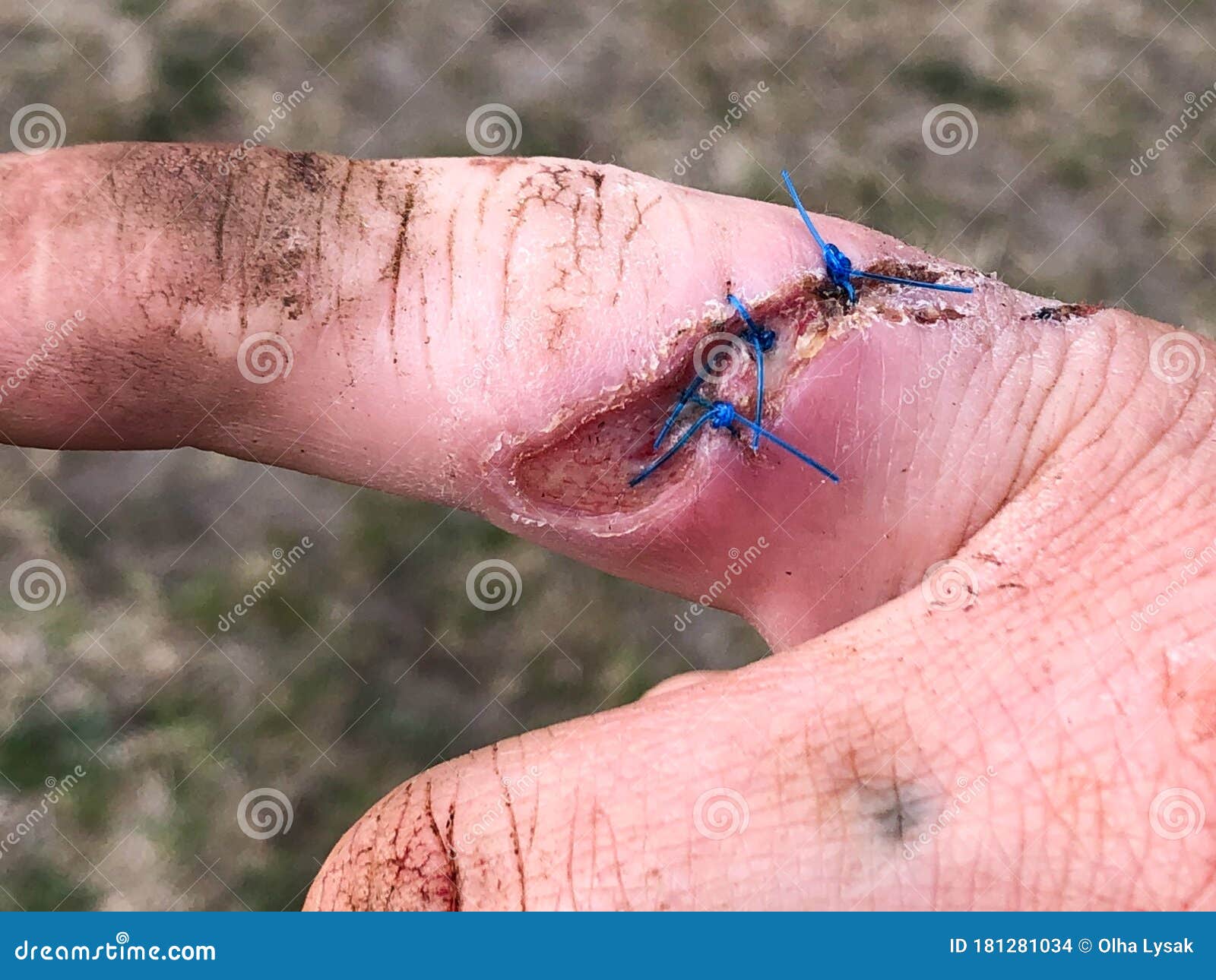 james staples cut fingers maine james staples cut fingers maine