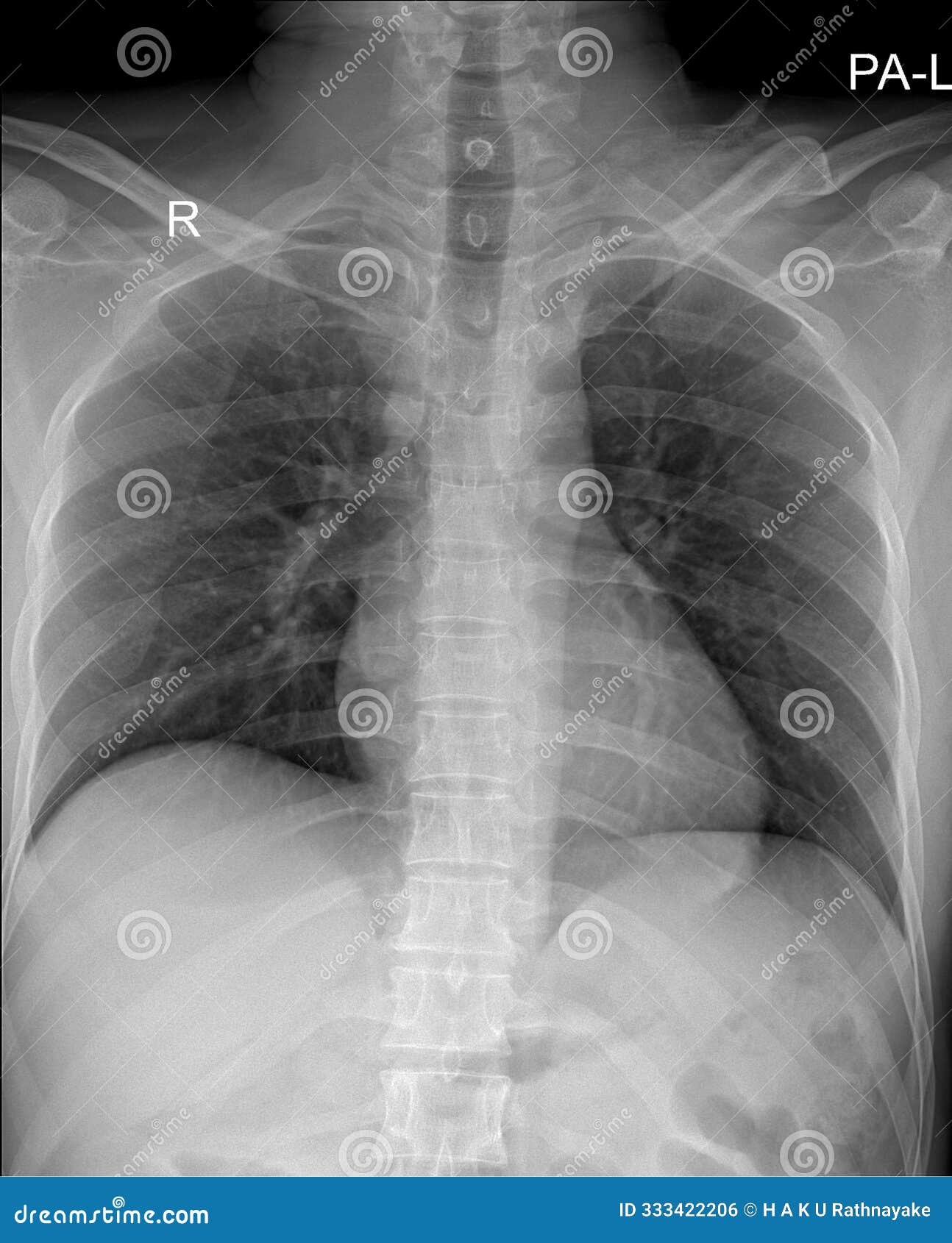 cxr x-ray: chest x-ray, a radiographic examination used to assess the chest cavity
