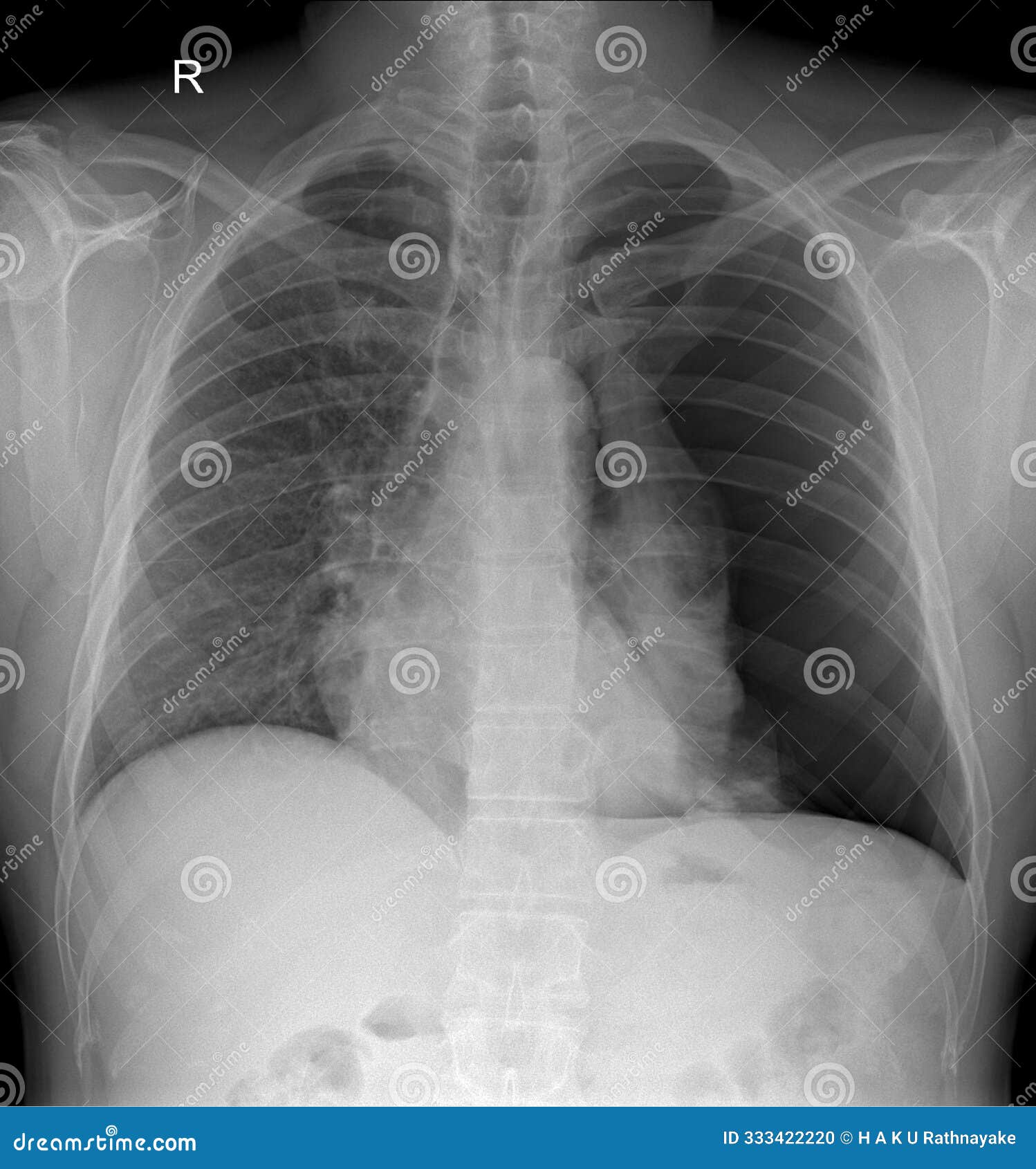 cxr x-ray: chest x-ray, a radiographic examination used to assess the chest cavity