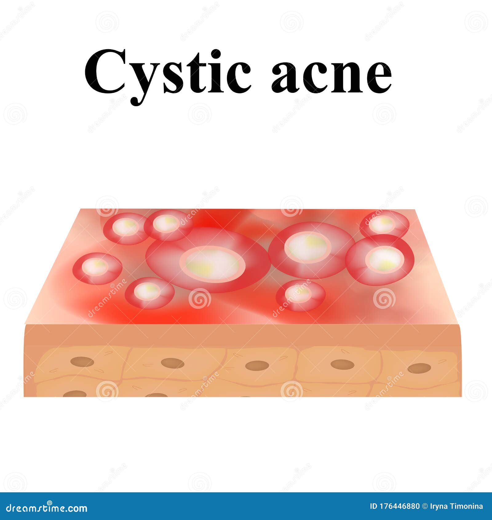 Cyst Acne. Acne on the Skin of a Cyst. Dermatological and Cosmetic ...