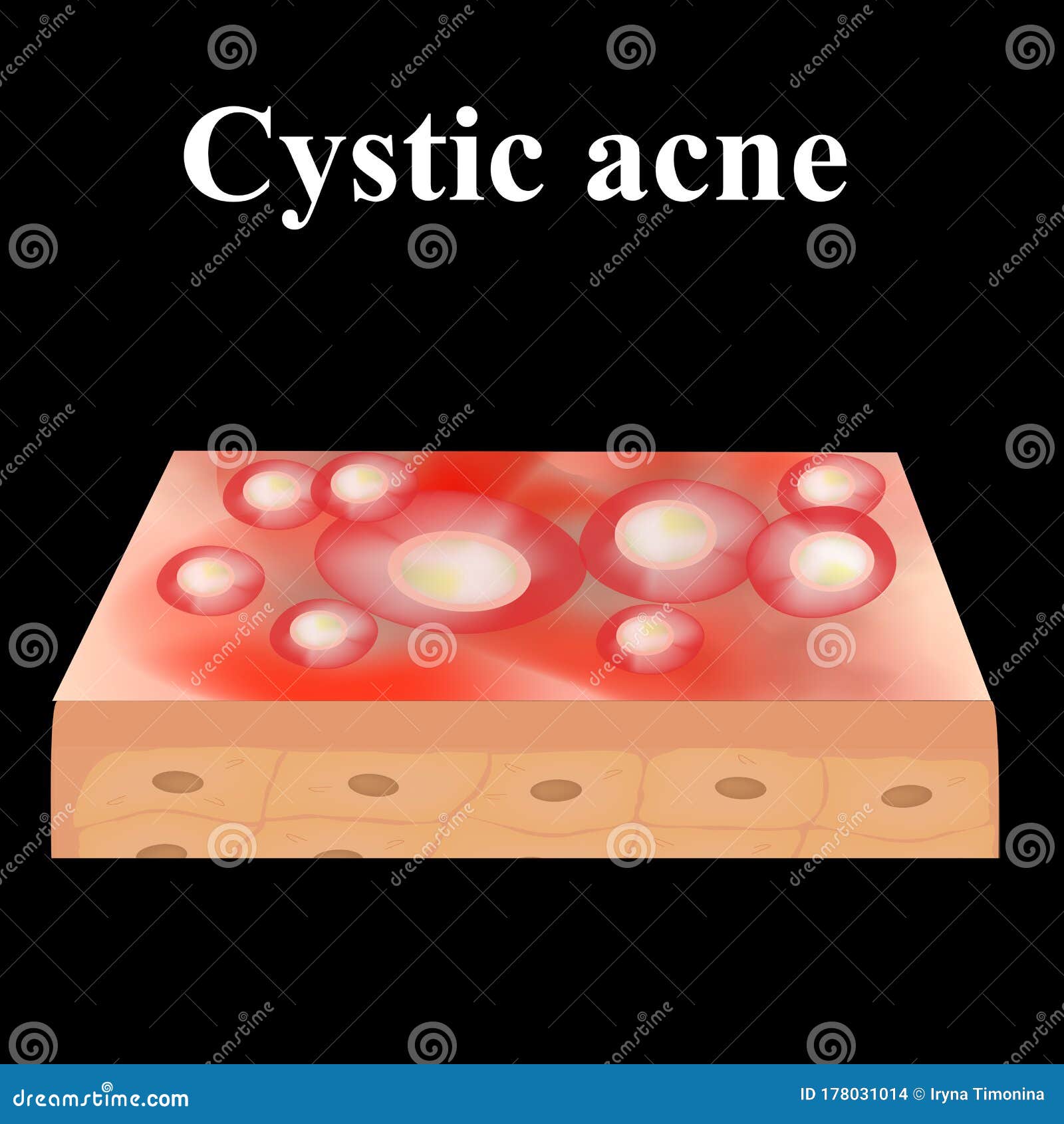 Cyst Acne. Acne On The Skin Of A Cyst. Dermatological And Cosmetic ...