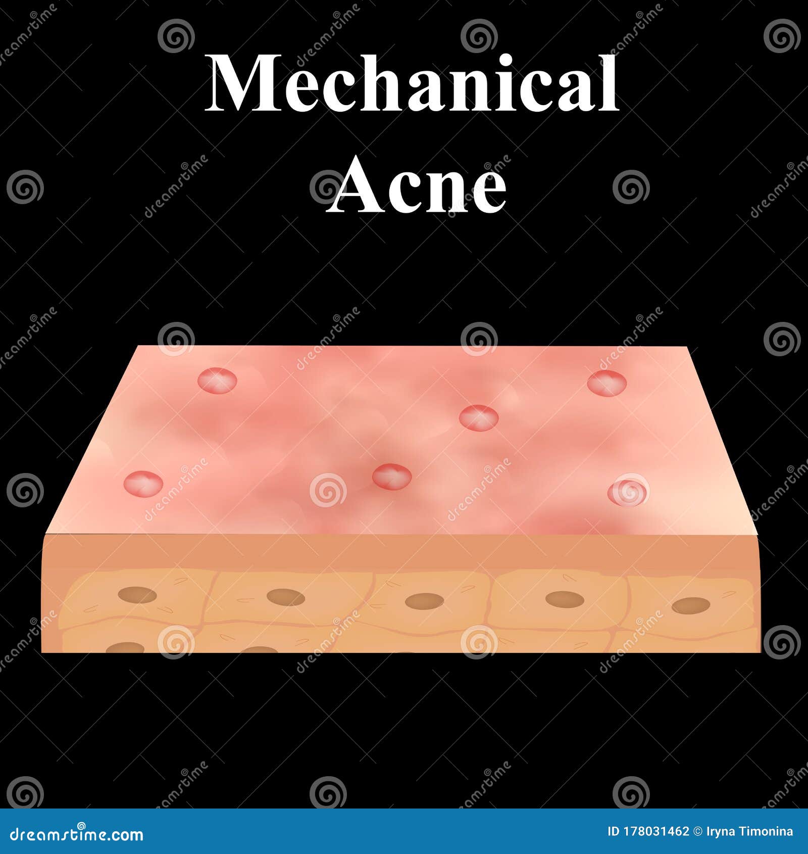 Cyst Acne. Acne on the Skin of a Cyst. Dermatological and Cosmetic ...