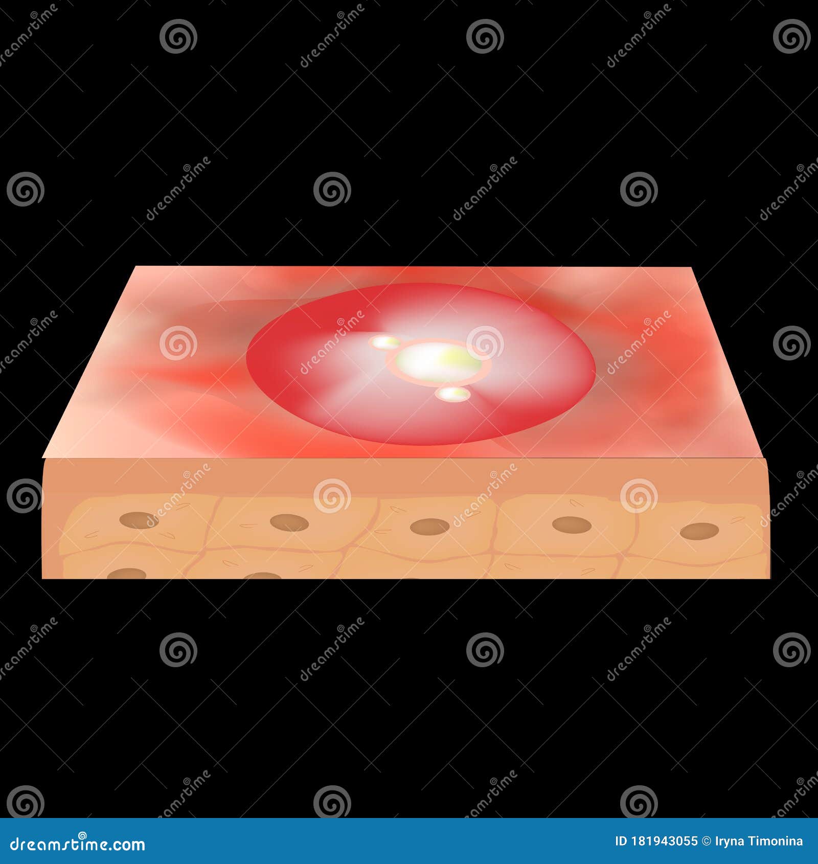 cyst acne. furuncle acne on the skin cysts and pimples. dermatological and cosmetic inflammatory diseases on the skin of