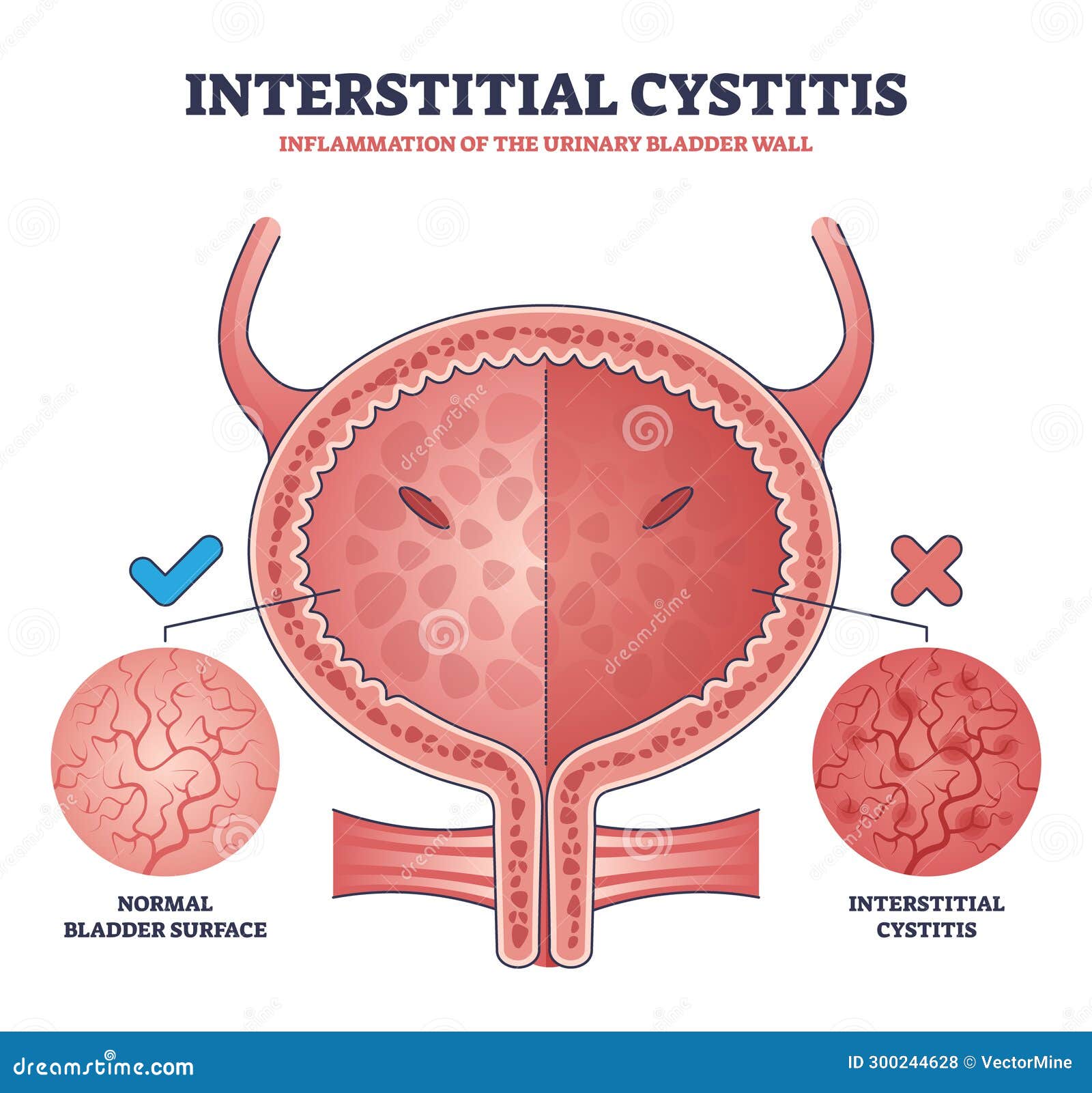 Cystite Interstitielle Comme Inflammation Murale Urinaire Schéma ...