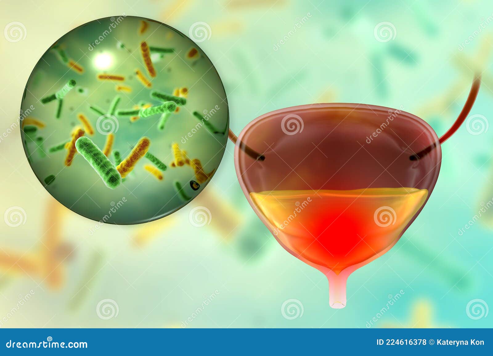 Cystitis Bacterial Infection Of Urinary Bladder Conceptual 3D cystitis-bacterial-infection-of-urinary-bladder-conceptual-3d