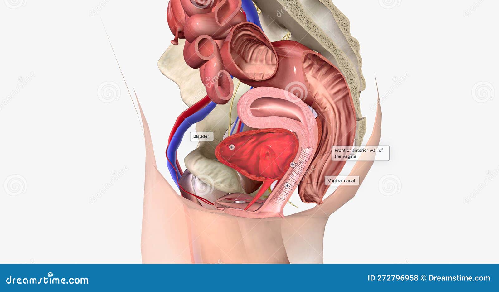 A Cystocele is Also Known As a Bladder Prolapse, a Fallen Bladder, a Prolapsed  Bladder, or an Anterior Vaginal Prolapse Stock Illustration - Illustration  of infection, cancer: 272796958