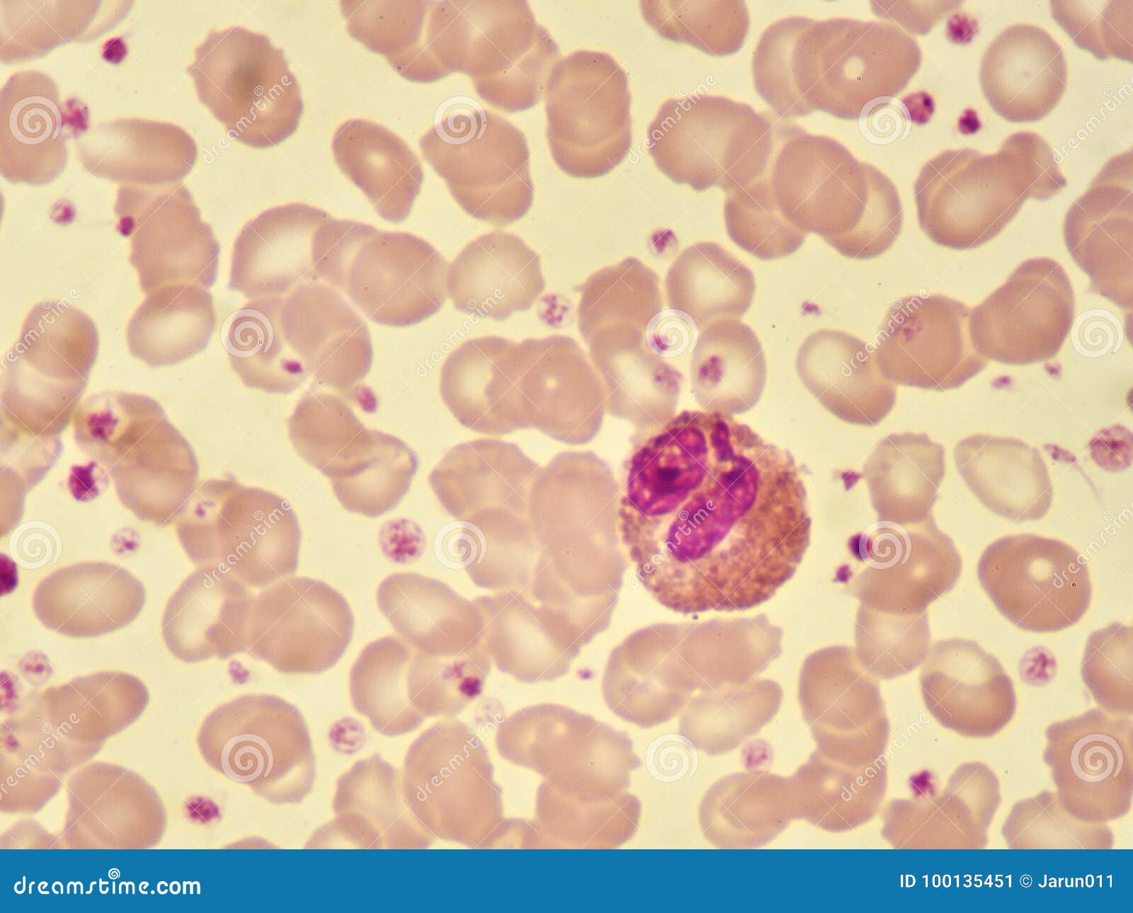 Célula del eosinófilo imagen de archivo. Imagen de salud 100135451