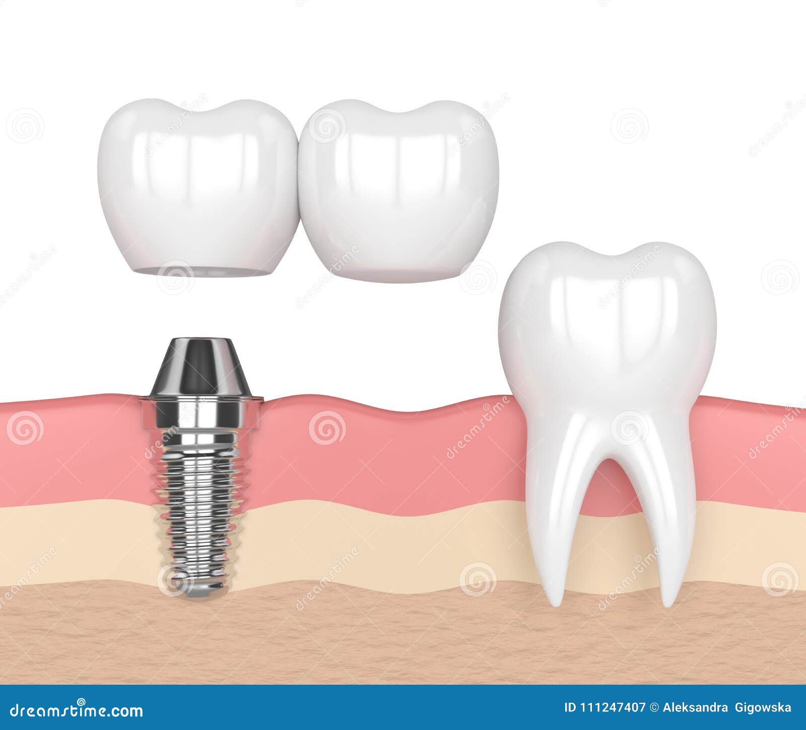 Коронка На Имплант Цена Москва