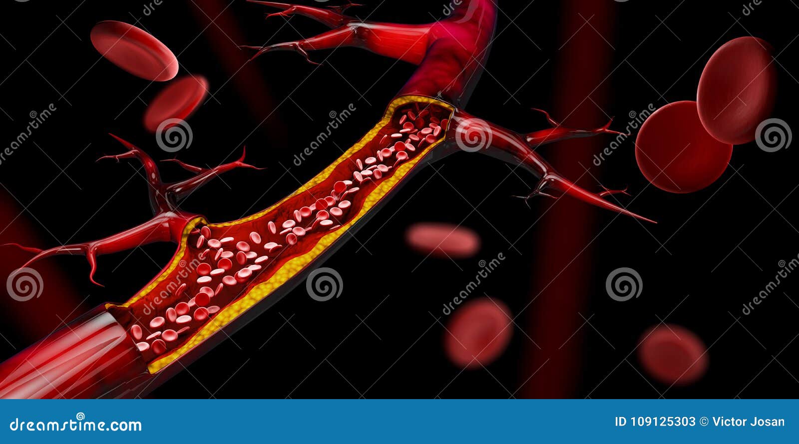 3d  of blocked blood vessel - artery with cholesterol buildup realistic