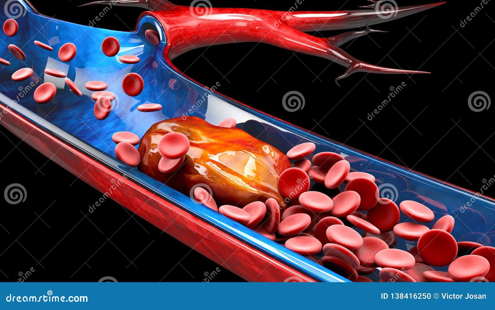 3d Illustration of Deep Vein Thrombosis or Blood Clots. Embolism Stock