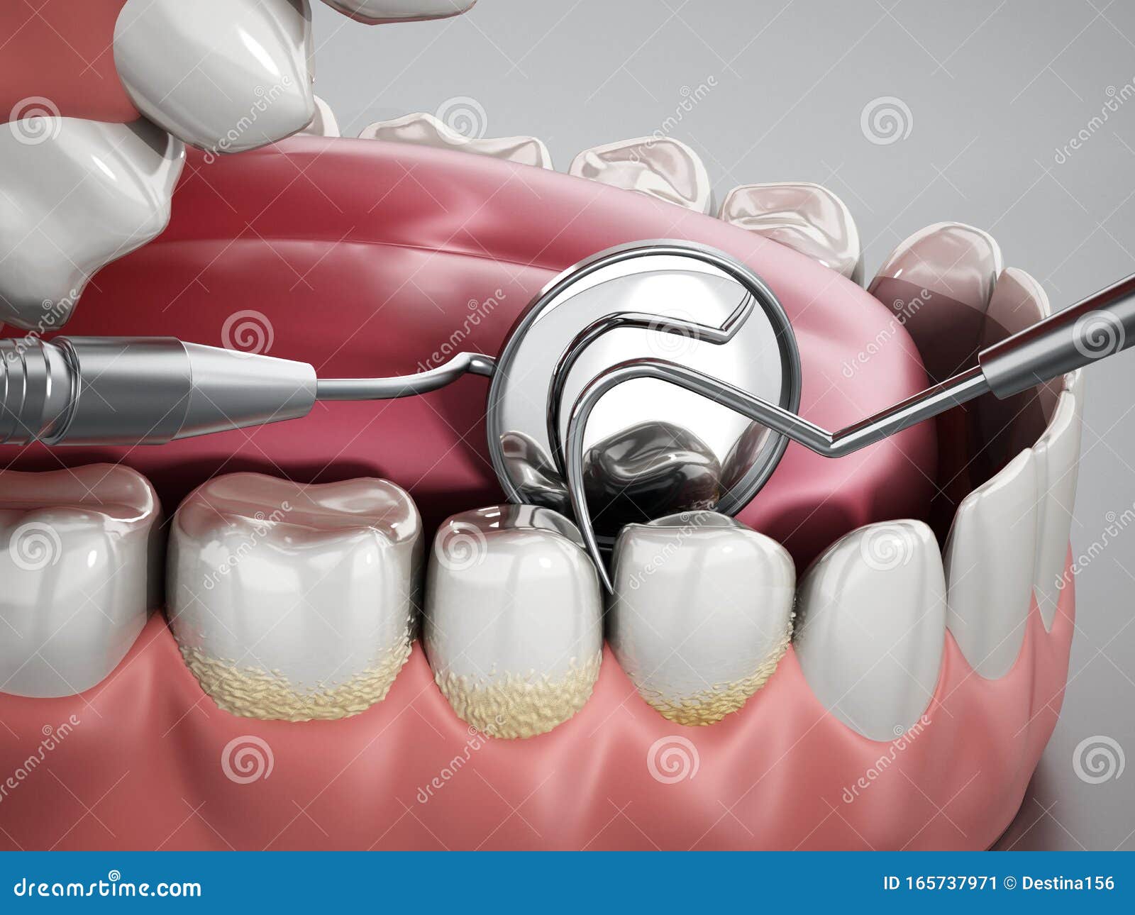 3D Illustration Showing Dentist Tools and Dental Plaque on Model. 3D