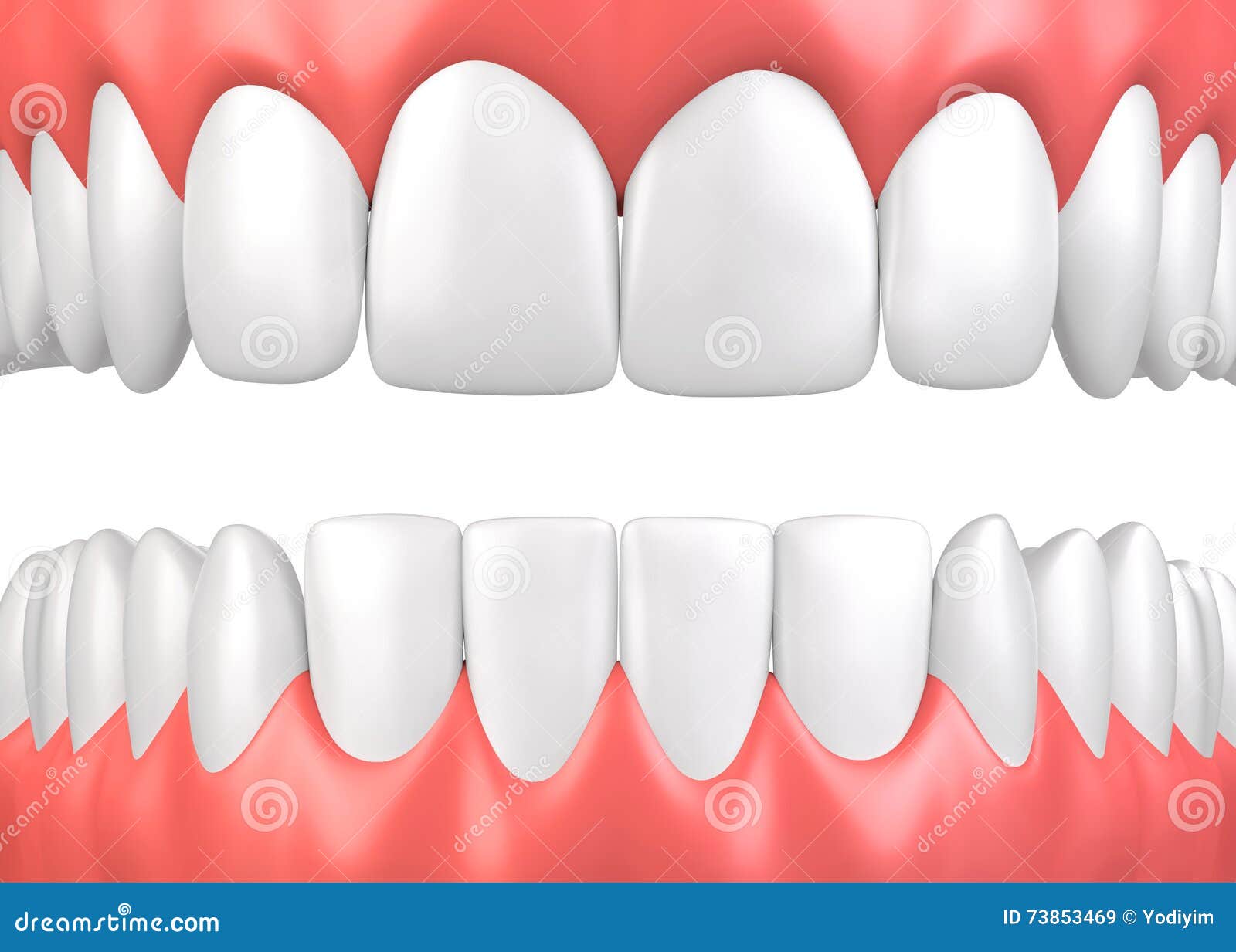 3d Illustration Of Teeth With Tartar Showing Four Different Phases In