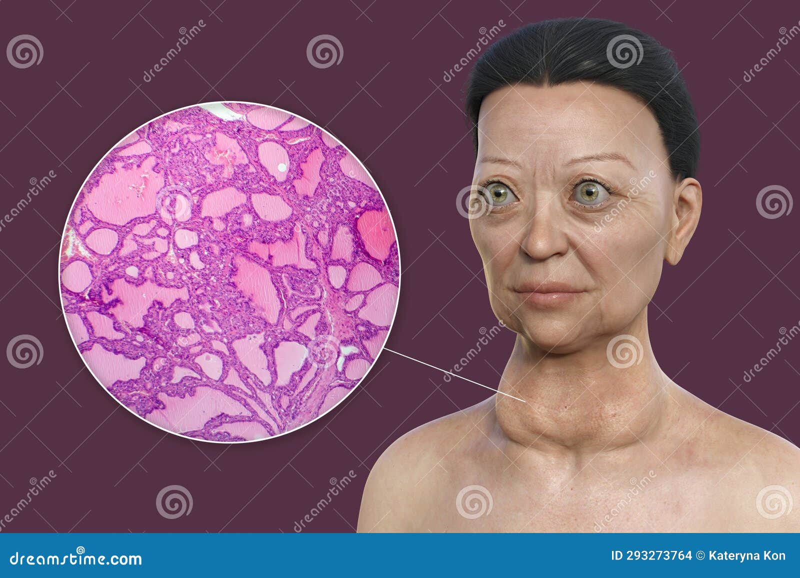 A 3D Illustration of a Woman with Graves Disease Alongside a Micrograph