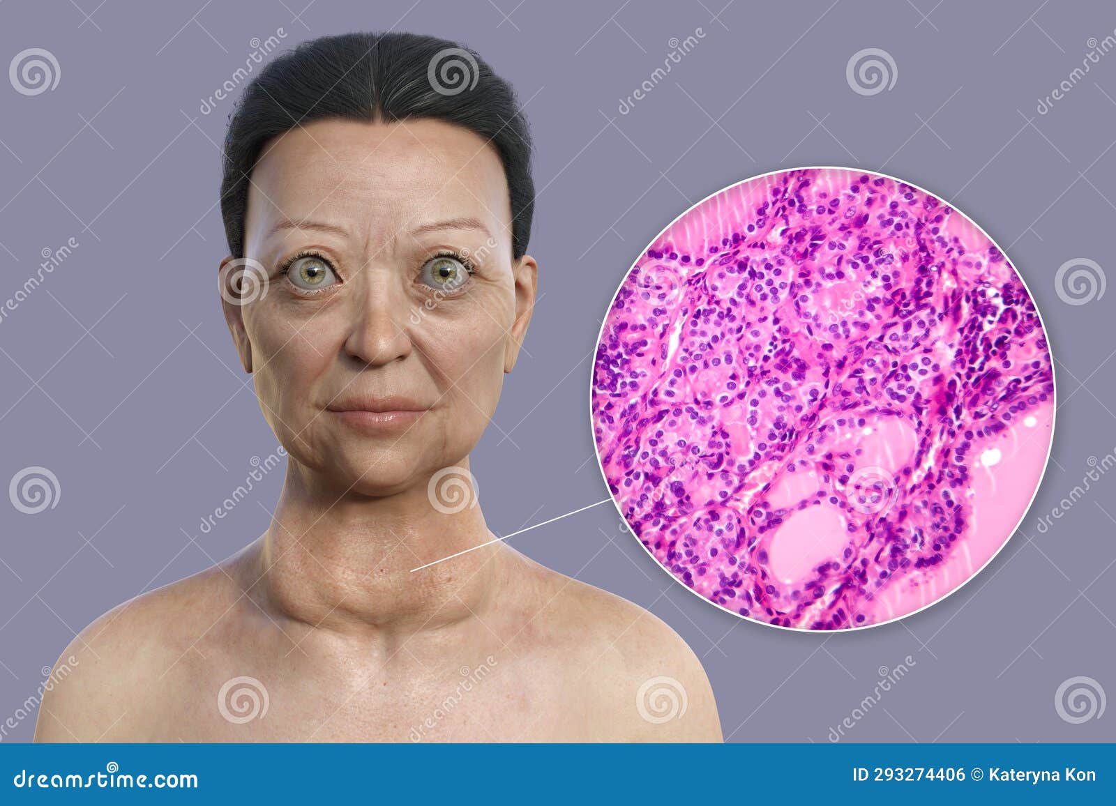 A 3D Illustration of a Woman with Graves Disease Alongside a Micrograph