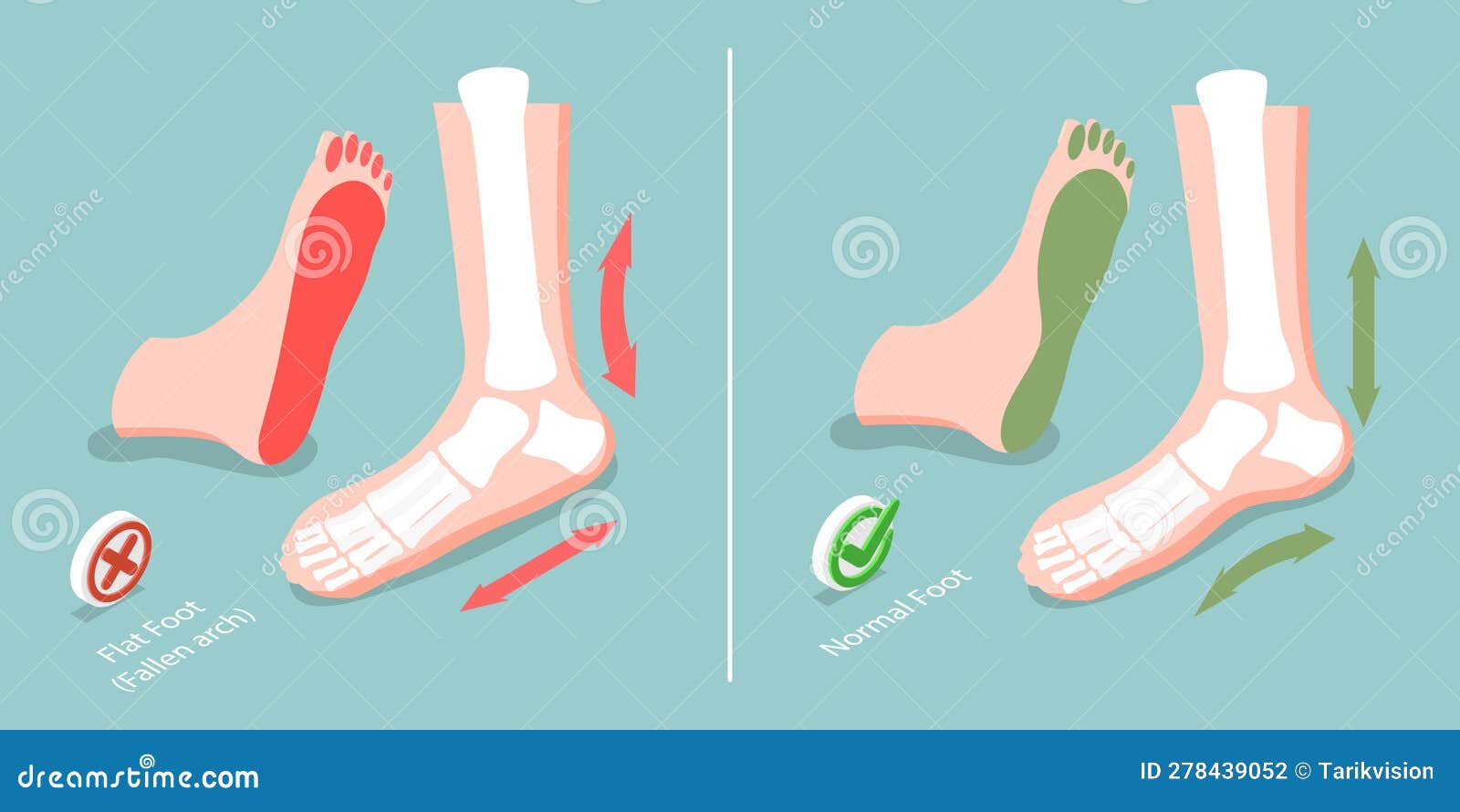 3D Isometric Flat Vector Conceptual Illustration of Flat Foot Stock