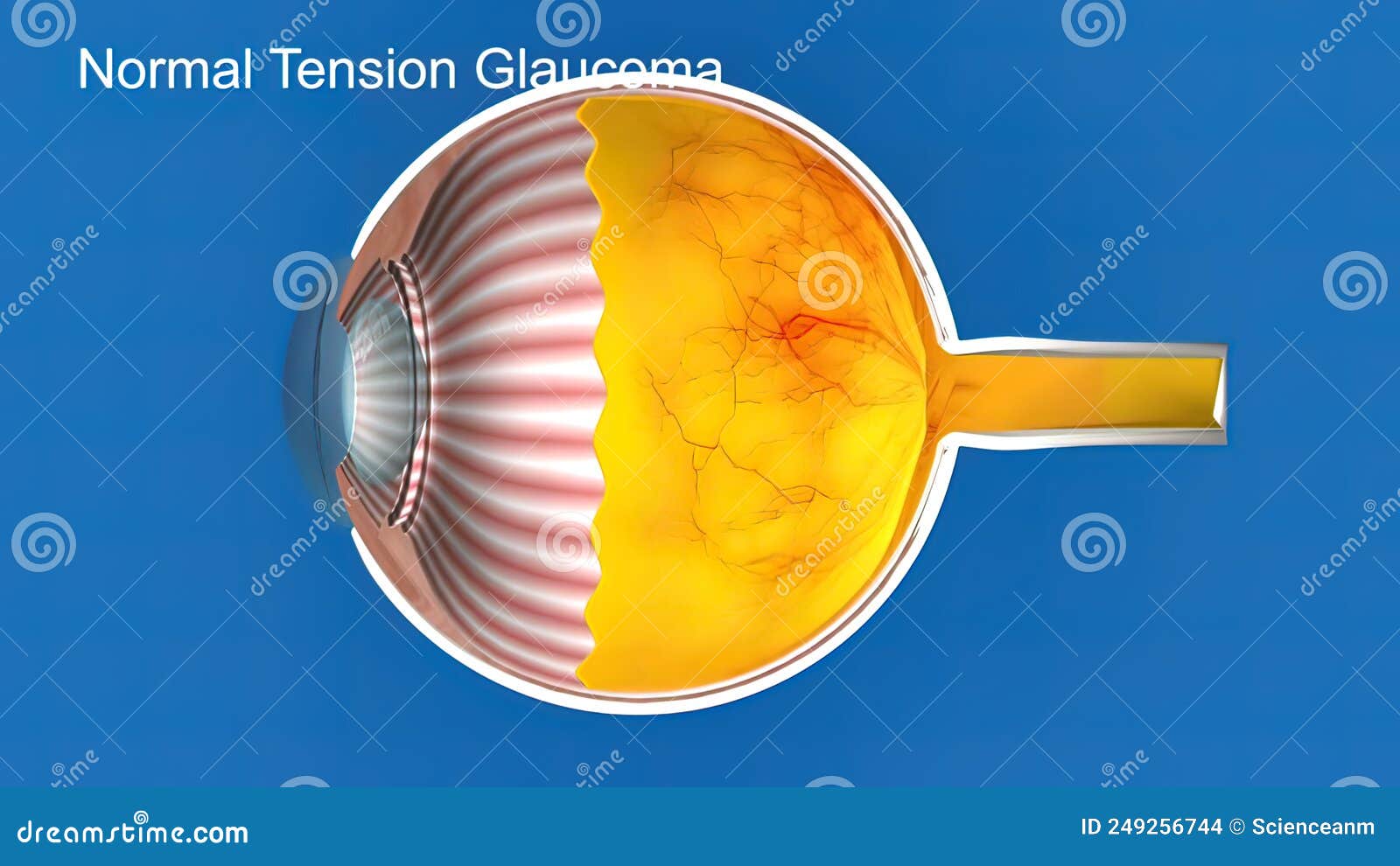 Normal Tension Glaucoma có thể là vấn đề sức khỏe nhạy cảm và mất điểm chức năng quan trọng đối với thị giác. Hình ảnh về Normal Tension Glaucoma sẽ giúp bạn hiểu rõ hơn về bệnh và và định hướng cho việc chăm sóc sức khỏe mắt một cách hiệu quả.