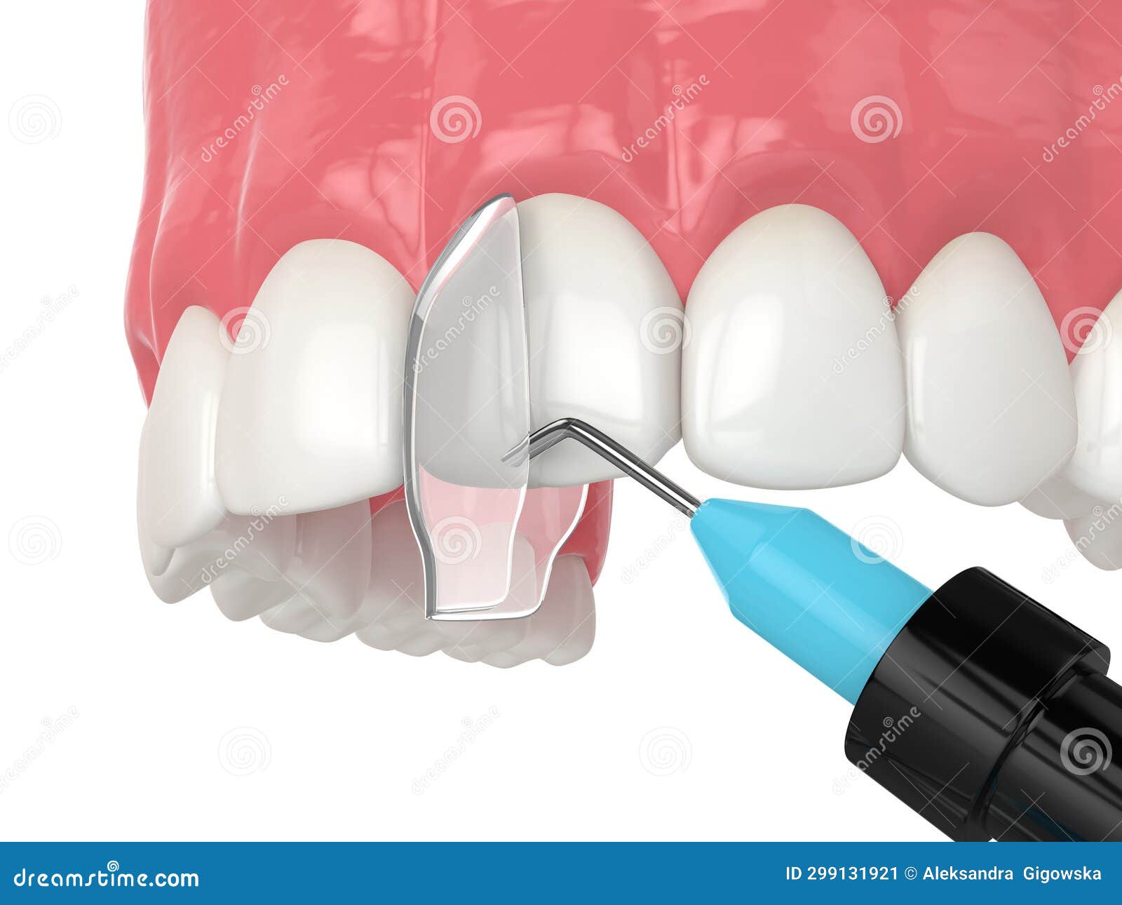3d Render of Crooked Tooth Treatment Using Bonding Procedure Stock Illustration Illustration