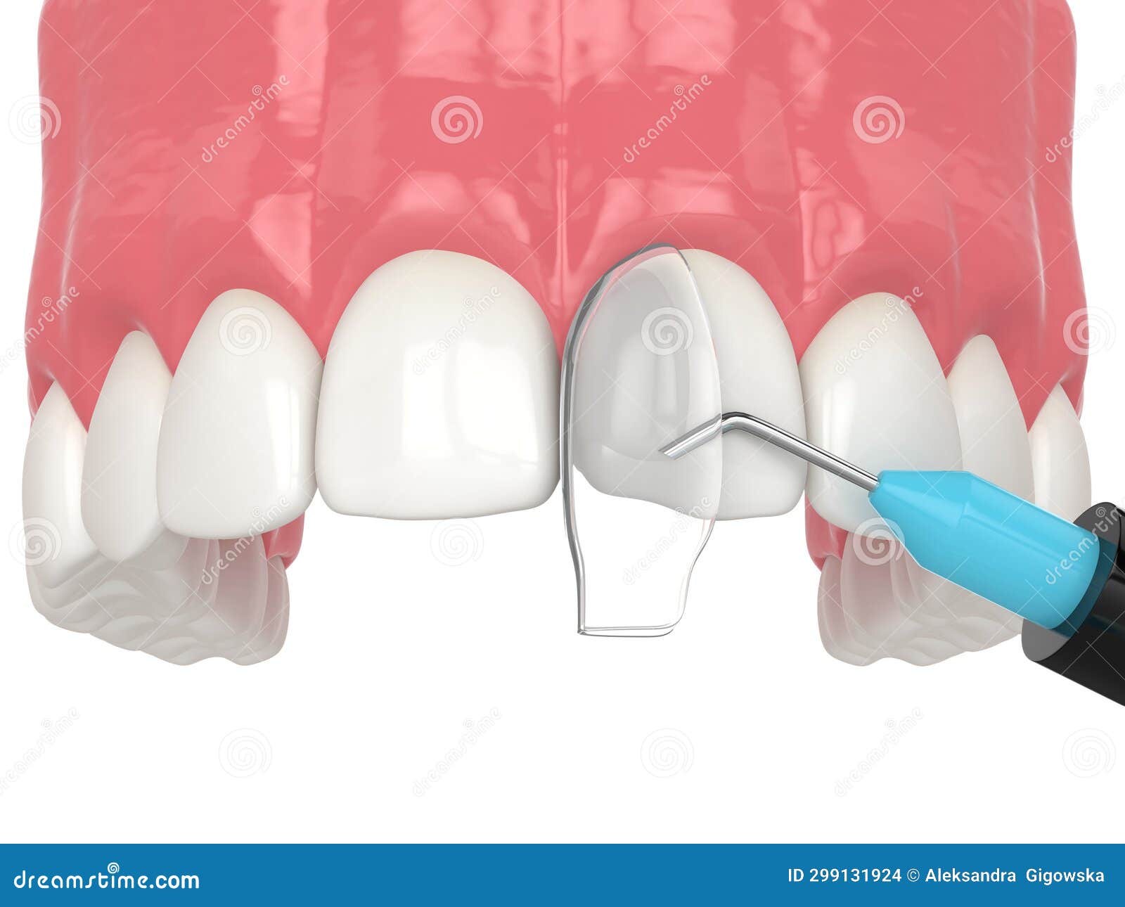 3d Render of Crooked Tooth Treatment Using Bonding Procedure Stock Illustration Illustration