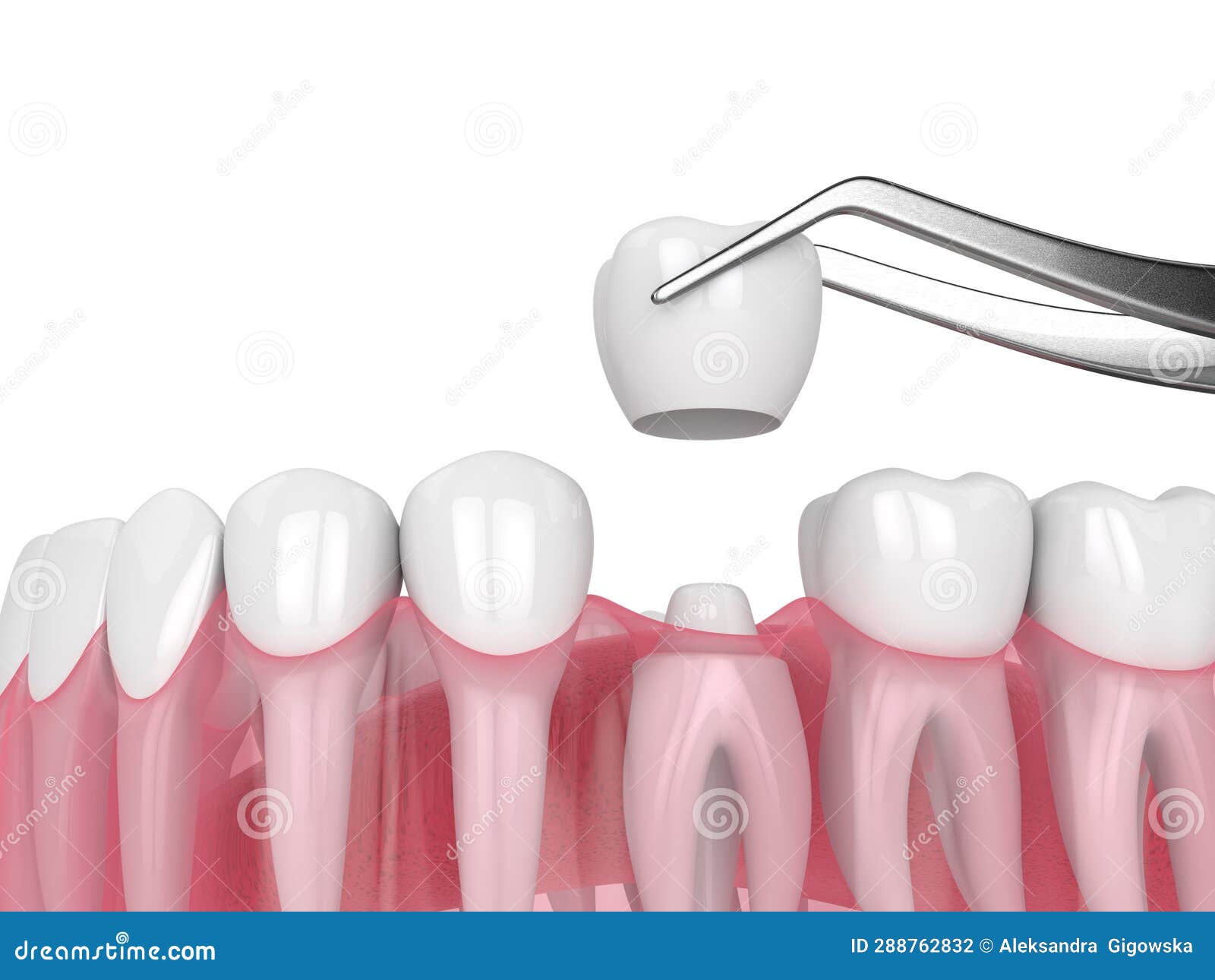 3d Render of Crown Replacement on Reshaped Tooth Stock Illustration