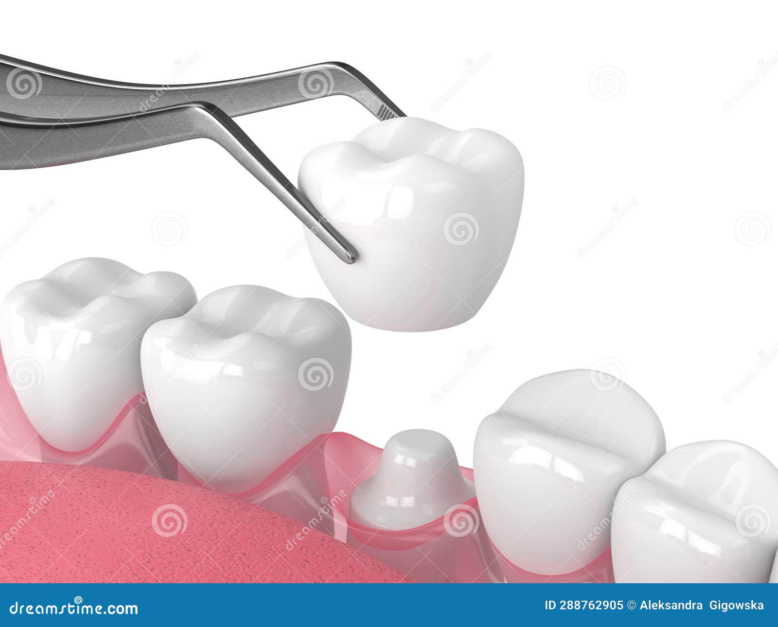 3d Render of Crown Replacement on Reshaped Tooth Stock Illustration