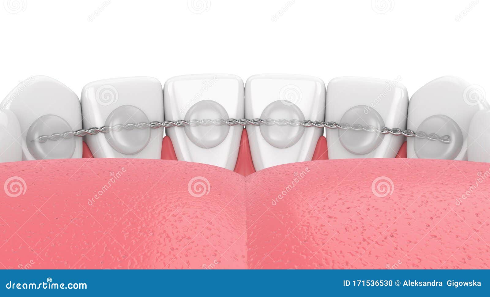 3d Render of Dental Bonded Retainer on Lower Jaw Stock Illustration