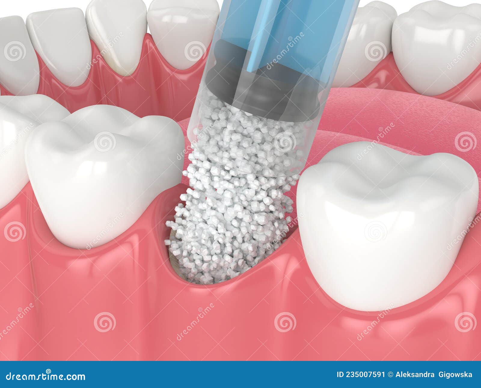 3D Render of Dental Bone Grafting with Dental Bone Biomaterial Application Stock Illustration