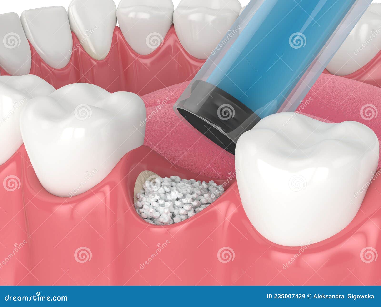 3D Render of Dental Bone Grafting with Dental Bone Biomaterial Application Stock Illustration