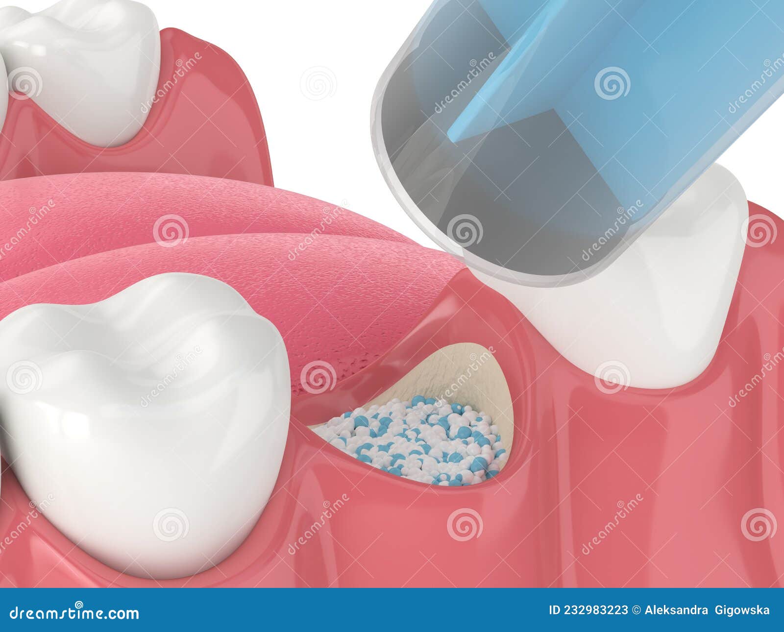 3D Render of Dental Bone Grafting with Dental Bone Biomaterial