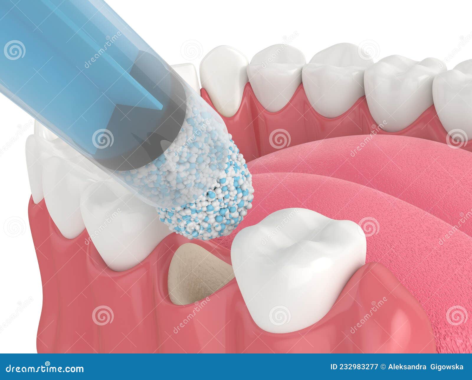 3D Render of Dental Bone Grafting with Dental Bone Biomaterial Application Stock Illustration