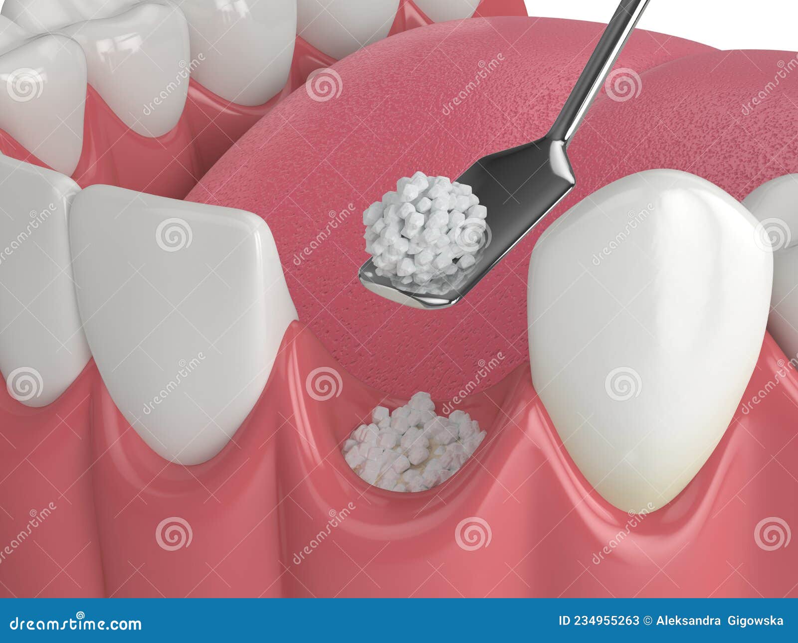 3D Render of Dental Bone Grafting with Dental Bone Biomaterial Stock