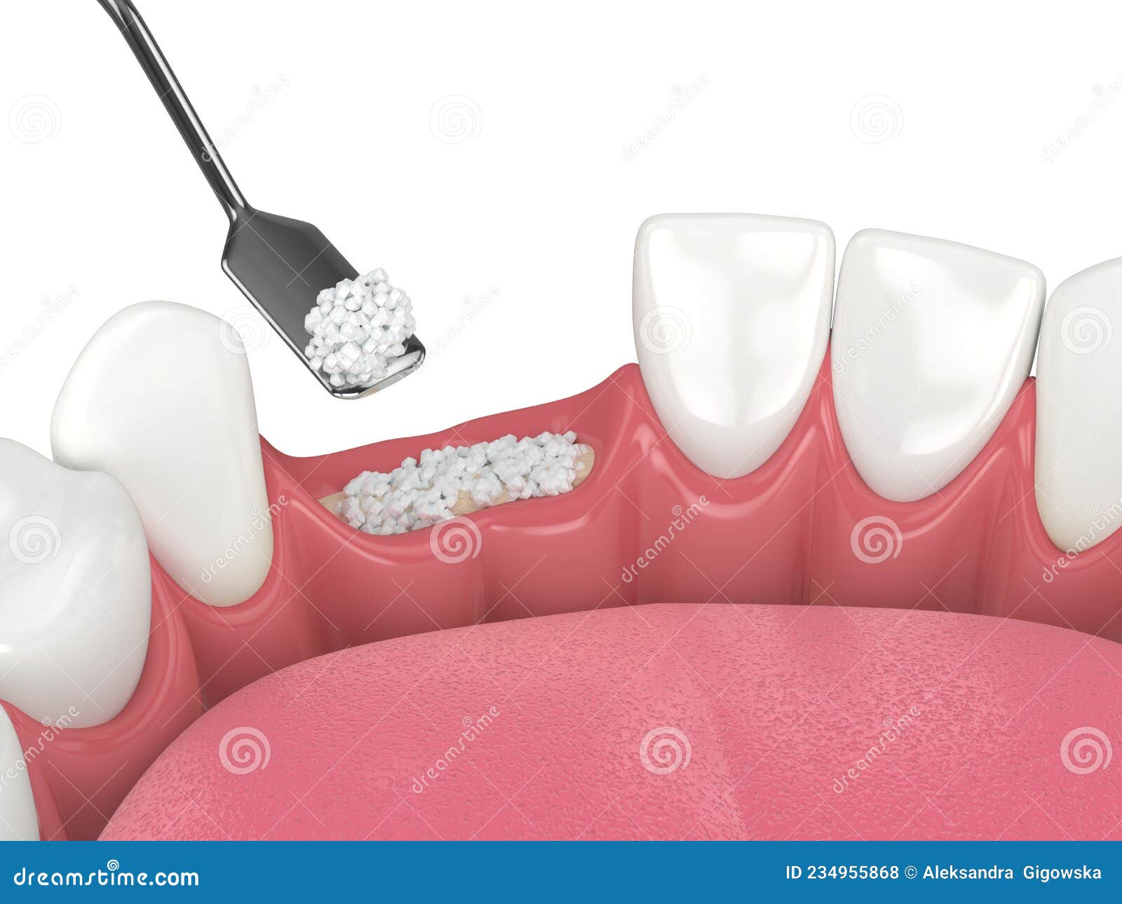 3D Render of Dental Bone Grafting with Dental Bone Biomaterial Stock