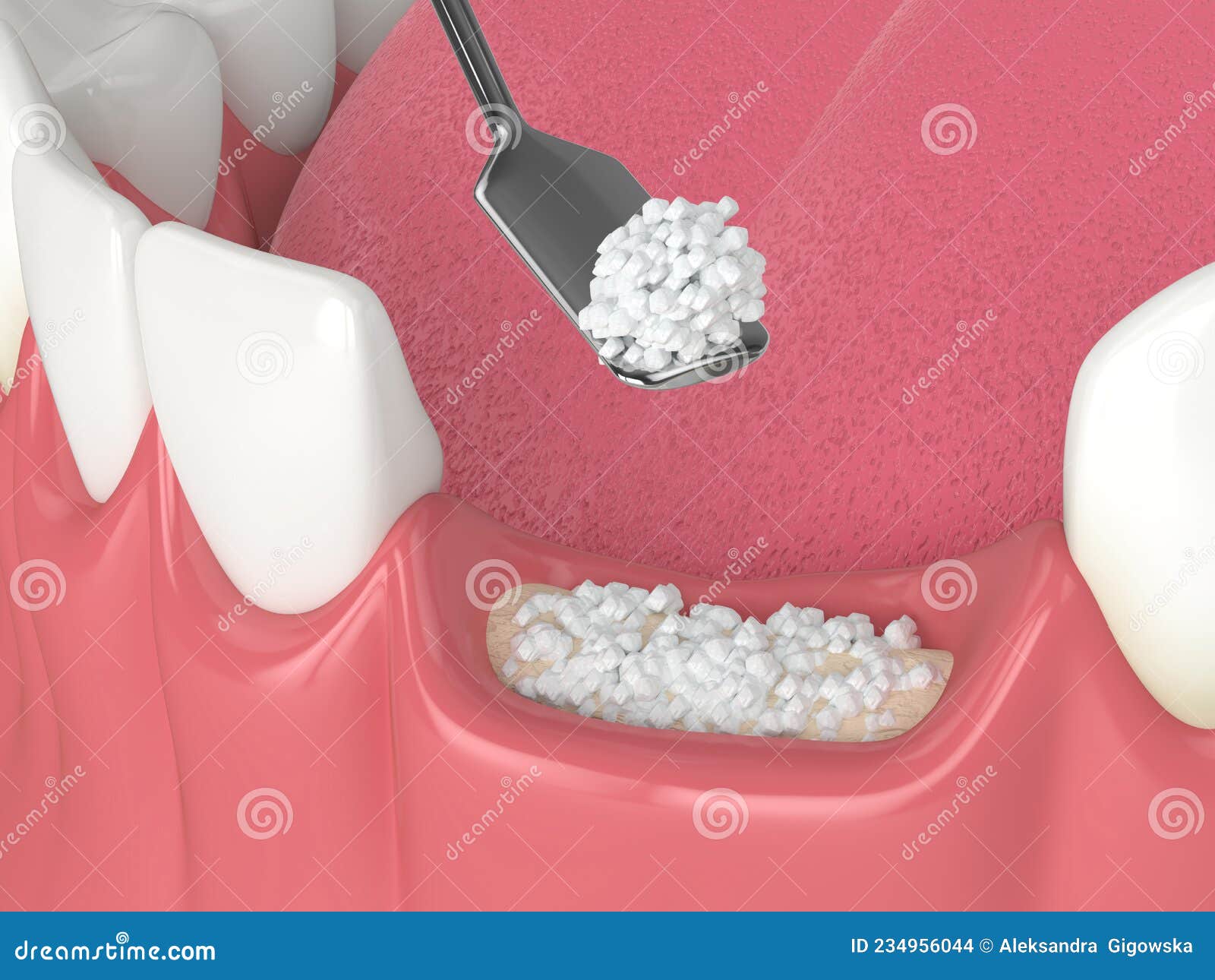 3d render of dental bone grafting with dental bone biomaterial