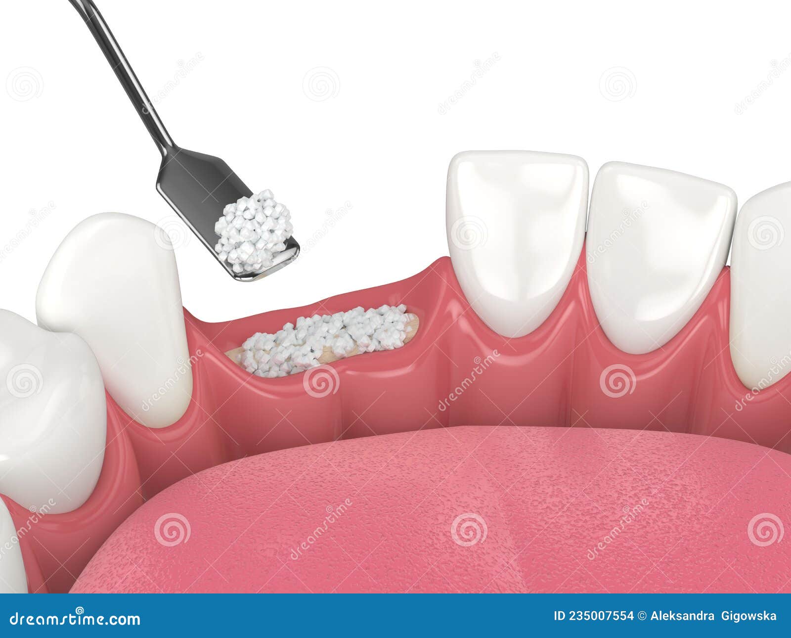 3D Render of Dental Bone Grafting with Dental Bone Biomaterial Stock