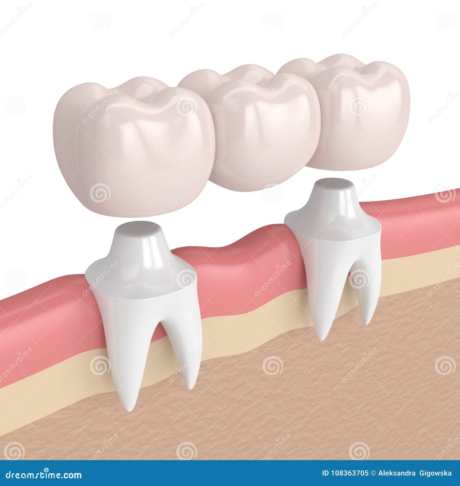 Dental Bridge Concept Vector Educational Poster, Diagram