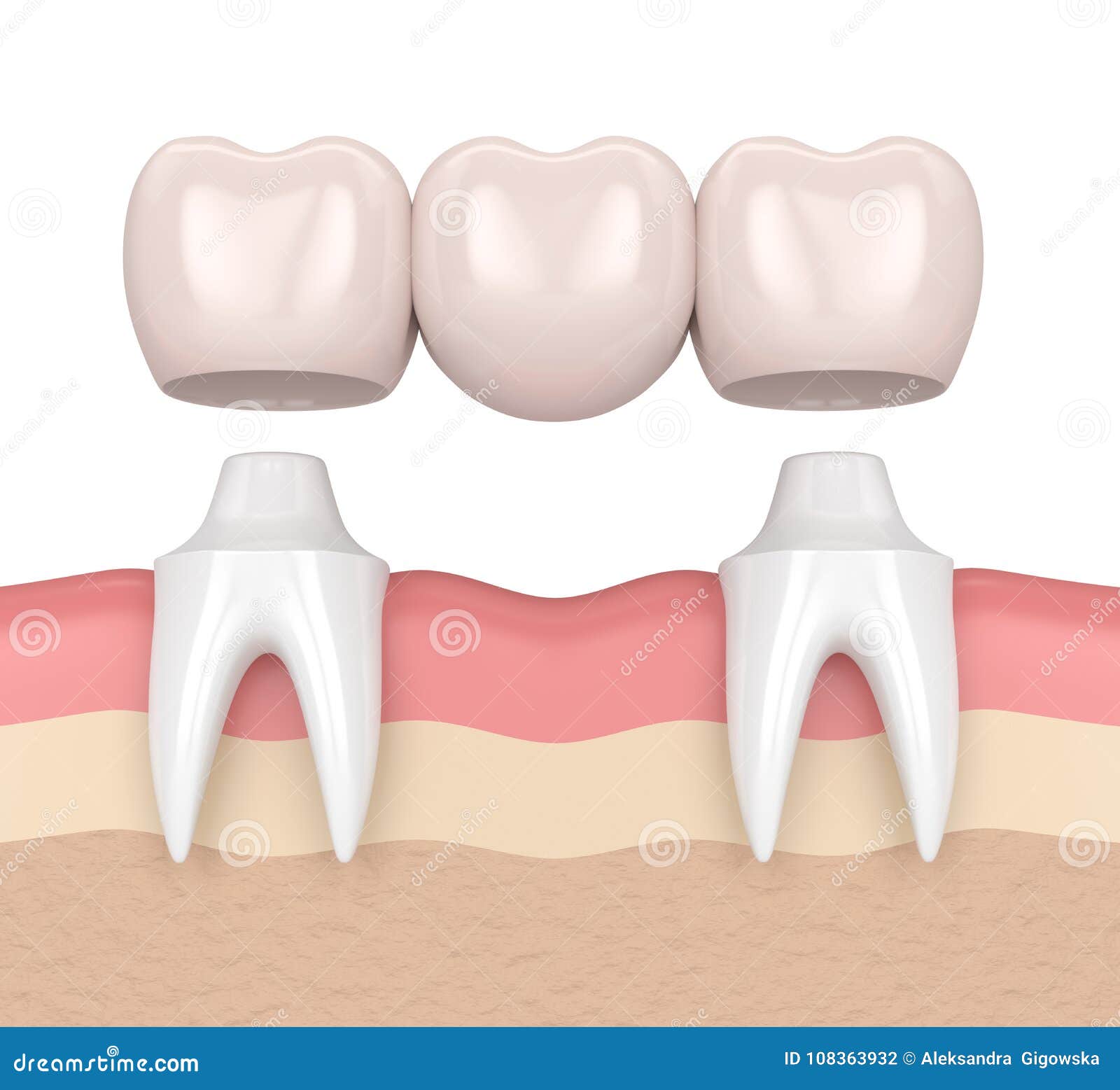 3d Render of Dental Bridge with Dental Crowns Stock Illustration