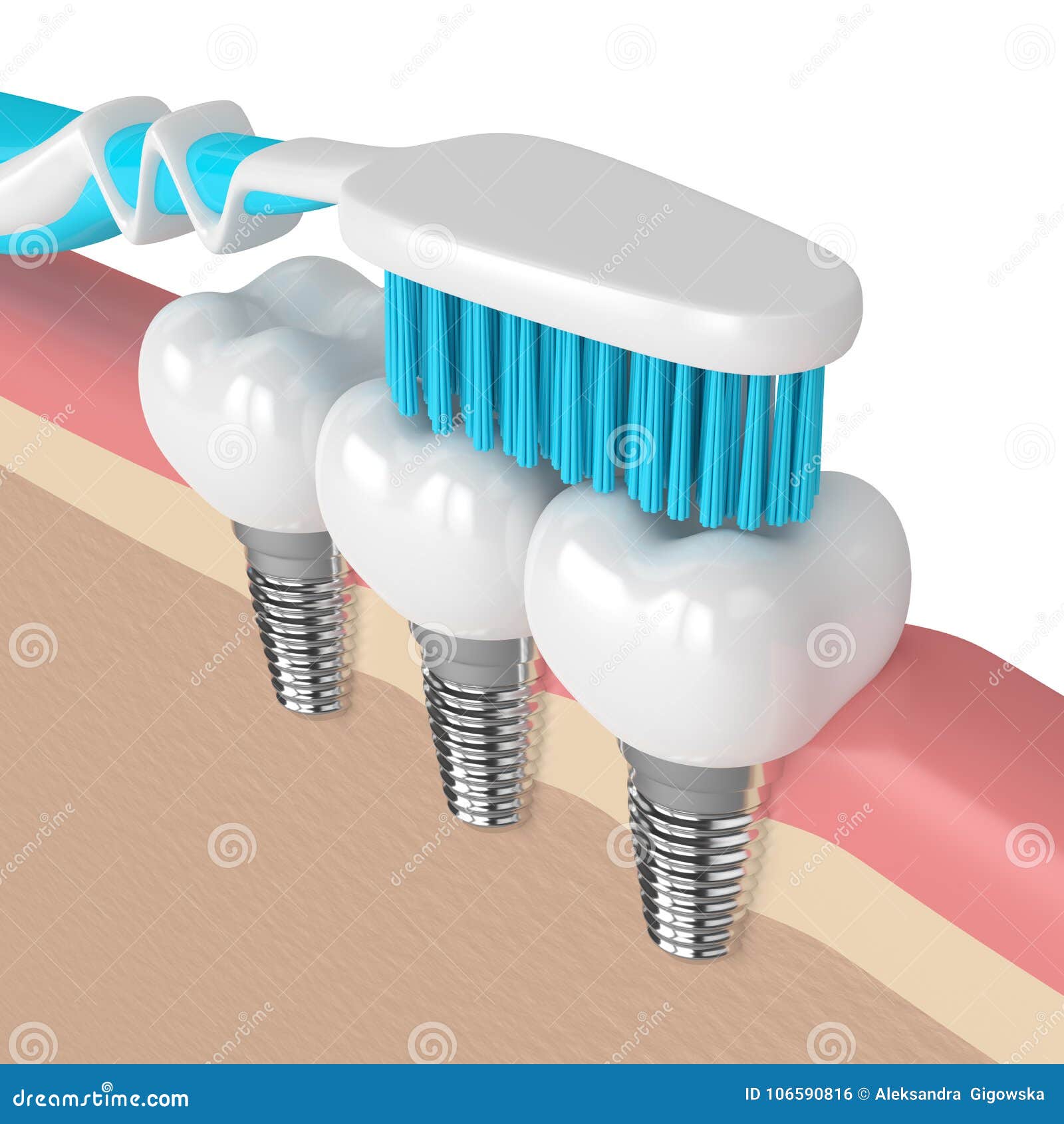 3d Render of Dental Implants with Toothbrush Stock Illustration