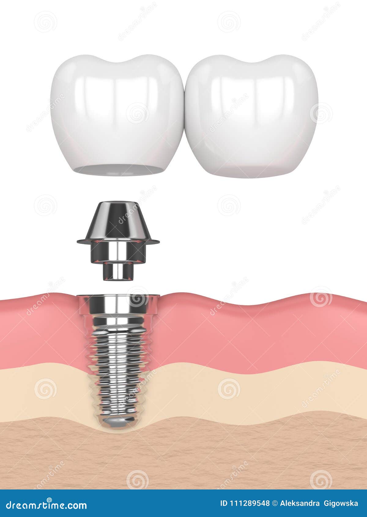 3d Render Of Jaw With Implant Screw And Buried Healing Cap Under Gums