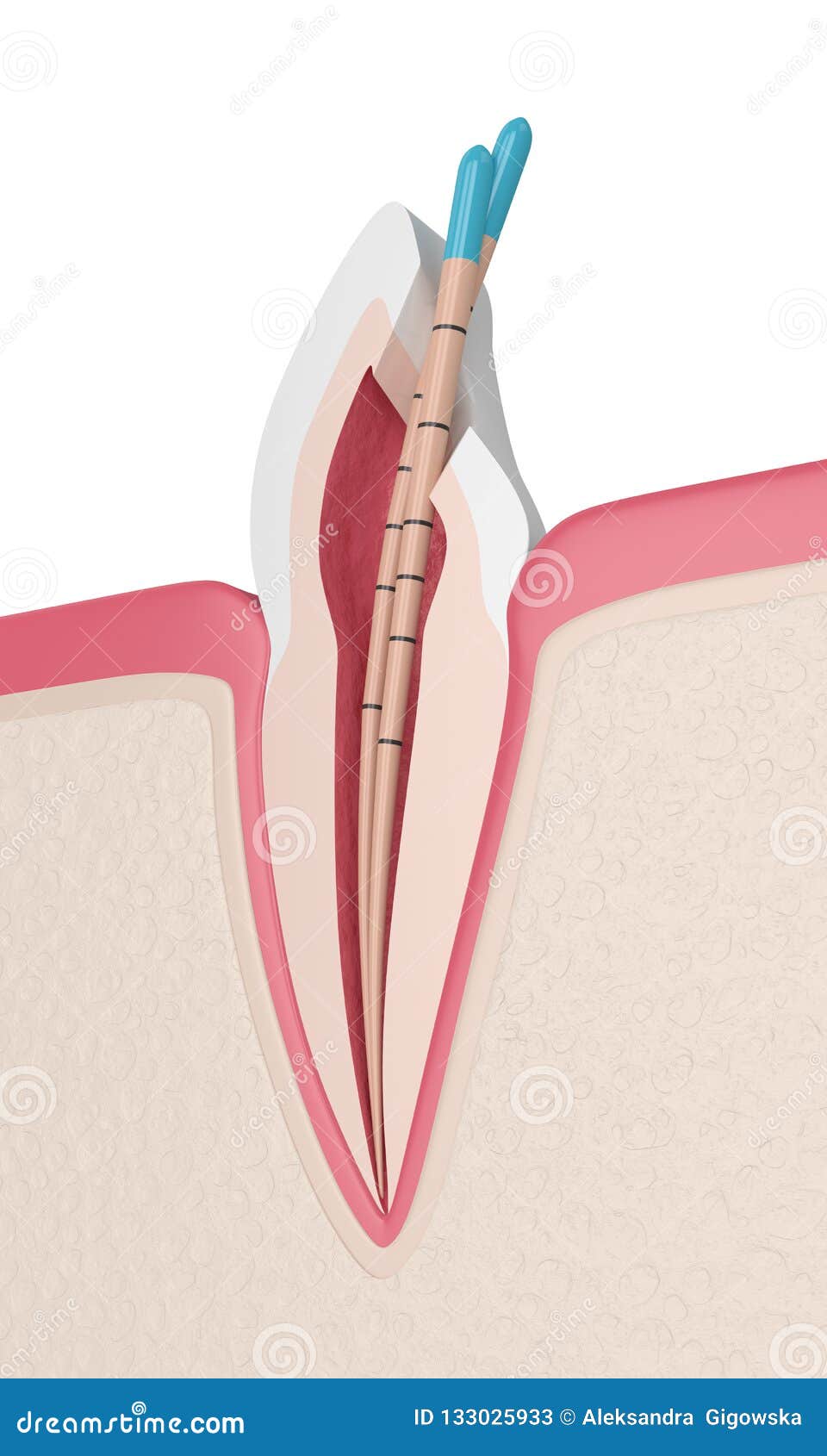 3d render of incisor tooth with gutta percha