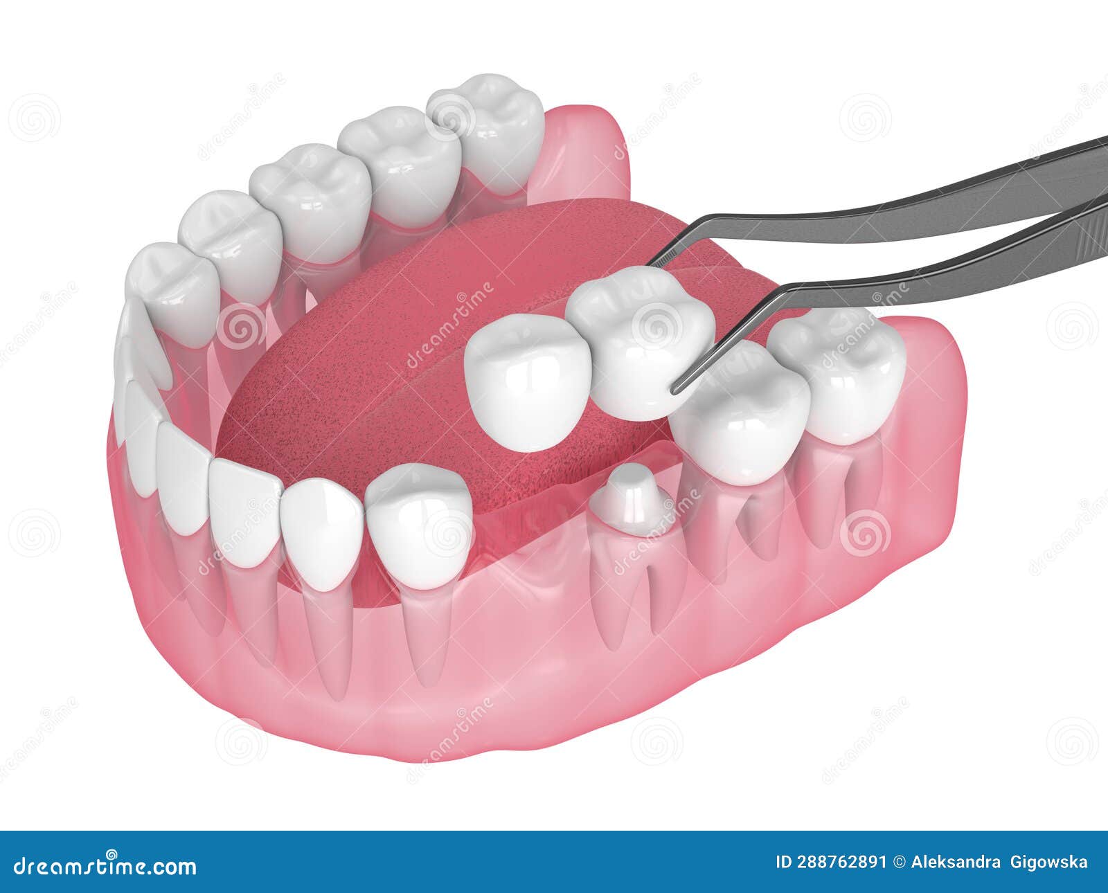 3d Render of Jaw with Dental Cantilever Bridge on Embedded Tooth Stock
