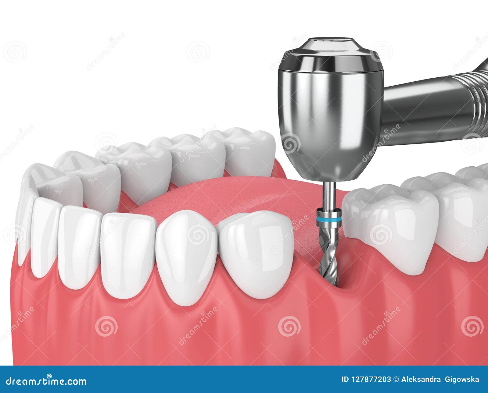 3d Render of Jaw with Dental Implant Drill Stock Illustration