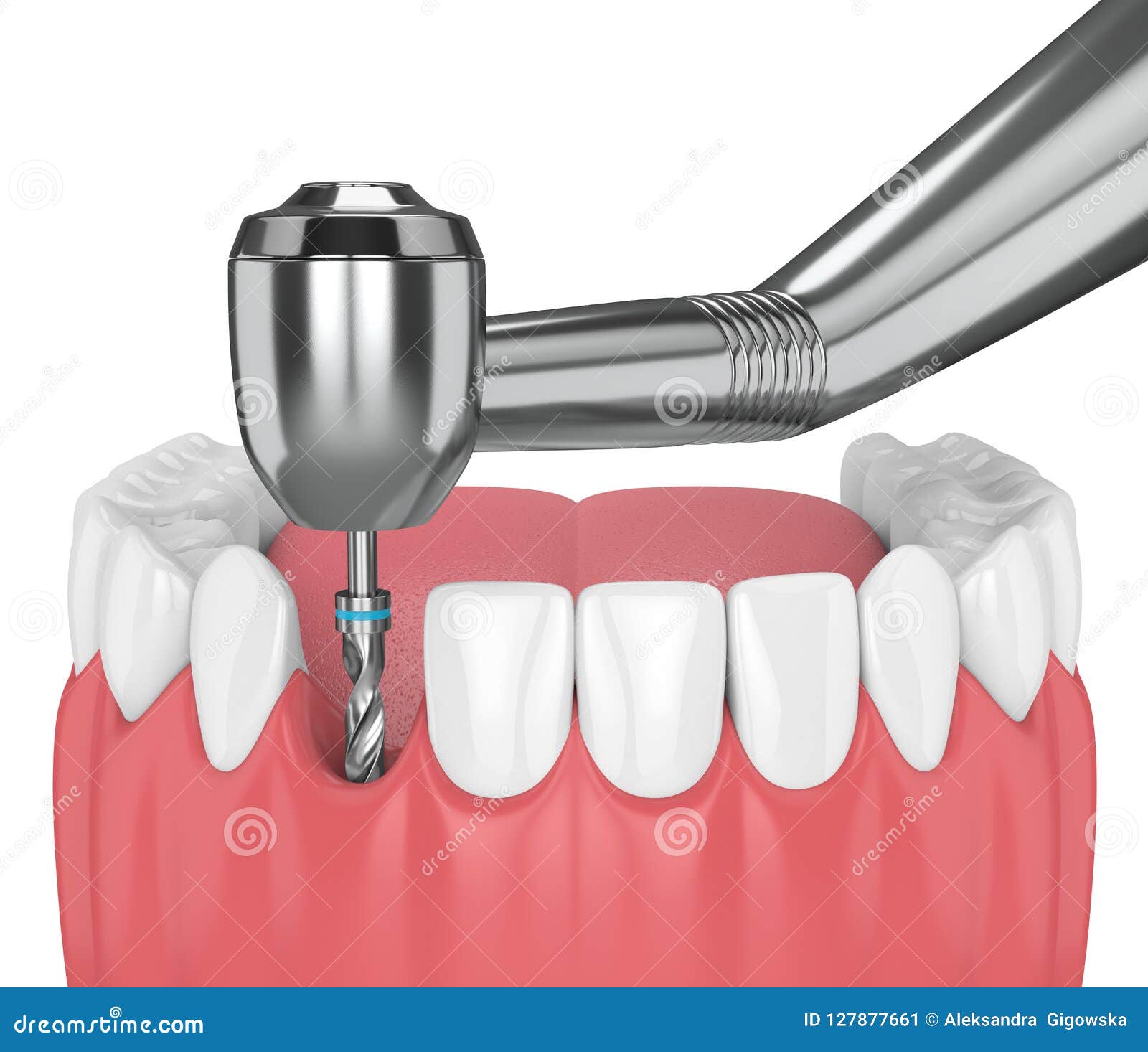 3d Render of Jaw with Dental Implant Drill Stock Illustration