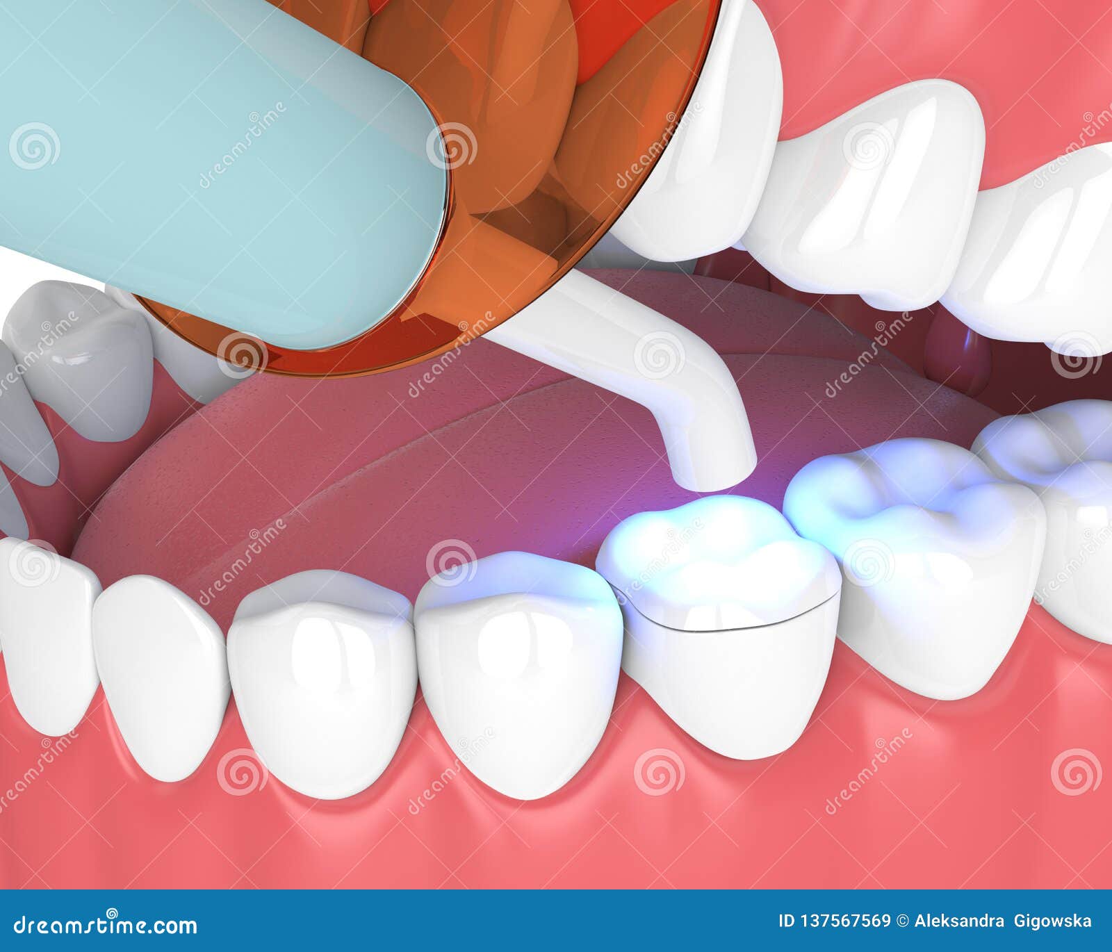 3d Render of Jaw with Dental Polymerization Lamp and Light Cured Onlay Stock Illustration
