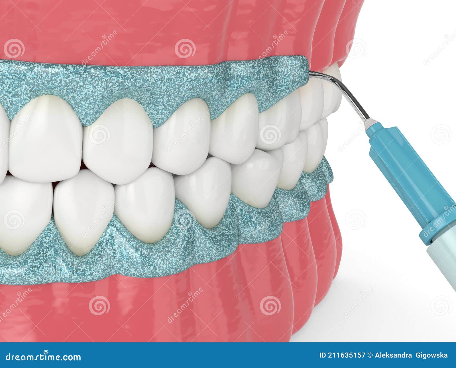3d Render of Jaw with Gingival Mask before Teeth Bleaching Stock